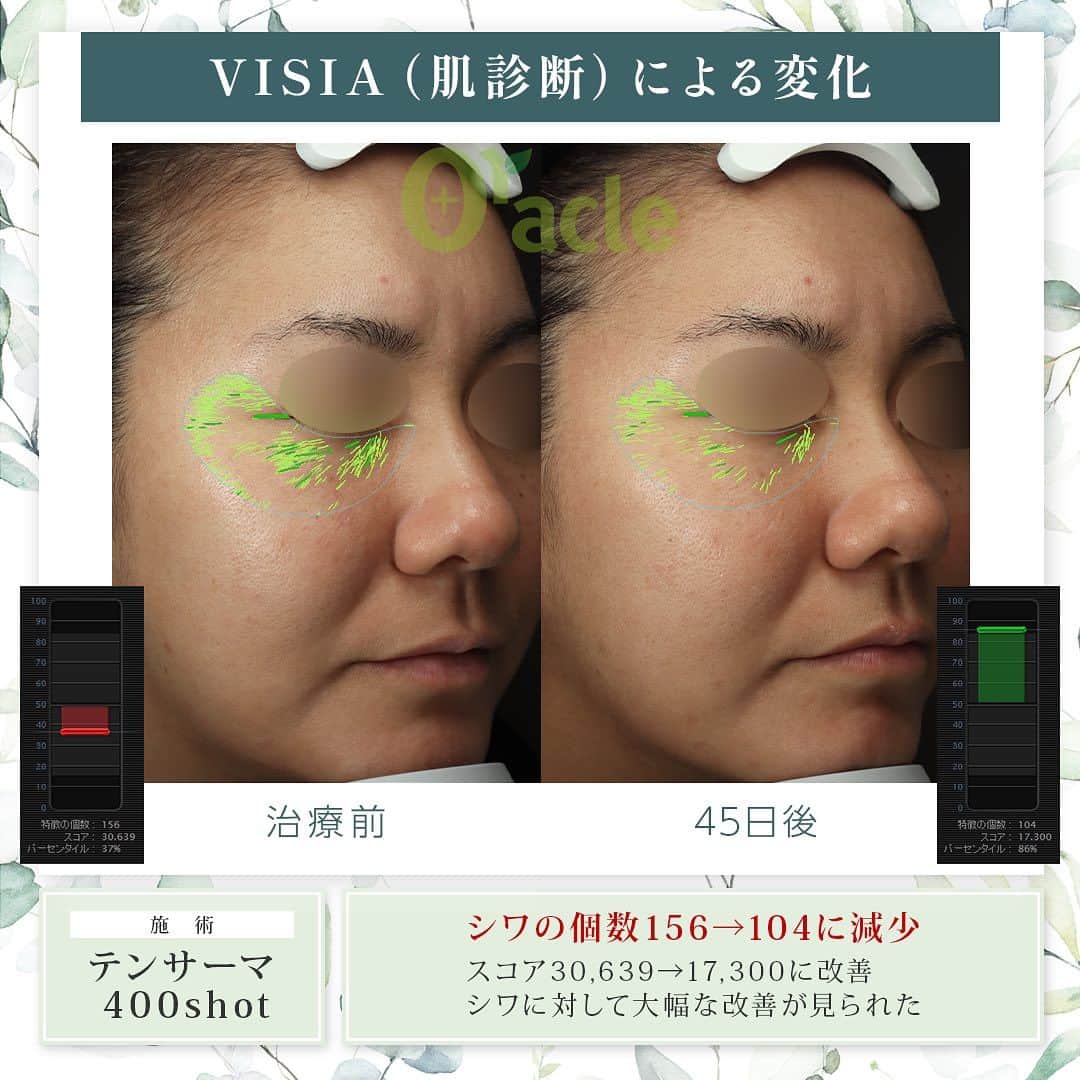 オラクル美容皮膚科東京新宿院さんのインスタグラム写真 - (オラクル美容皮膚科東京新宿院Instagram)「◤高周波によるたるみ治療症例◢| 《治療内容》 10サーマ（テンサーマ）1回 →45日後経過（VISIA）による測定  ☑️10サーマ 治療目的▶肌のハリ、毛穴引き締め、小じわ フェイスラインやほうれい線のたるみ改善  モノポーラ式高周波を用いた引き締め治療。 ●韓国のMFDS承認機器 ※日本の厚生労働省にあたる機関 ●各種特許取得  🇰🇷韓国で2022年11月にリリースの最新機種 韓国では高周波が人気で、韓国国内外で400以上導入されています。  【ダウンタイム】▶︎ほぼありません 赤み：ほぼなし、出ても数時間から1日程度 洗顔、メイクは当日から◎ ⁡ 【料金】 対象院☞新宿院 間もなく名古屋院、福岡天神院開始  認定看護師コース　 初回 400shot 98,000円（税込） ⁡ ※認定看護師とは 10サーマのKOLで学会発表やセミナー活動を行っている古市雅子統括院長の認定を受けた看護師のことを言います。  医師施術（新宿院のみ） 200shot 88,000円（気になる部分） 400shot 165,000円（全顔） 600shot 220,000円（全顔＋顎下） ※全て税込  #10therma #テンサーマ #10サーマ #高周波 #引き締め #たるみ #弾力 #韓国 #美容 #フェイスライン #ほうれい線 #美容皮膚科 #アンチエイジング #韓国好きな人と繋がりたい #韓国情報  #たるみ改善 #若返り #顔痩せ」10月14日 18時44分 - oraclejp