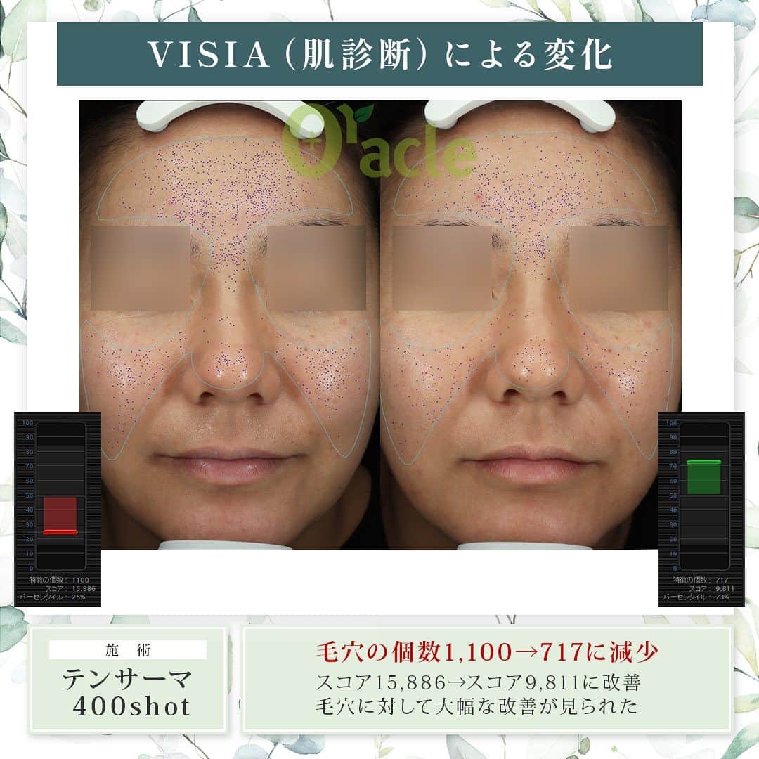 オラクル美容皮膚科東京新宿院さんのインスタグラム写真 - (オラクル美容皮膚科東京新宿院Instagram)「◤高周波によるたるみ治療症例◢| 《治療内容》 10サーマ（テンサーマ）1回 →45日後経過（VISIA）による測定  ☑️10サーマ 治療目的▶肌のハリ、毛穴引き締め、小じわ フェイスラインやほうれい線のたるみ改善  モノポーラ式高周波を用いた引き締め治療。 ●韓国のMFDS承認機器 ※日本の厚生労働省にあたる機関 ●各種特許取得  🇰🇷韓国で2022年11月にリリースの最新機種 韓国では高周波が人気で、韓国国内外で400以上導入されています。  【ダウンタイム】▶︎ほぼありません 赤み：ほぼなし、出ても数時間から1日程度 洗顔、メイクは当日から◎ ⁡ 【料金】 対象院☞新宿院 間もなく名古屋院、福岡天神院開始  認定看護師コース　 初回 400shot 98,000円（税込） ⁡ ※認定看護師とは 10サーマのKOLで学会発表やセミナー活動を行っている古市雅子統括院長の認定を受けた看護師のことを言います。  医師施術（新宿院のみ） 200shot 88,000円（気になる部分） 400shot 165,000円（全顔） 600shot 220,000円（全顔＋顎下） ※全て税込  #10therma #テンサーマ #10サーマ #高周波 #引き締め #たるみ #弾力 #韓国 #美容 #フェイスライン #ほうれい線 #美容皮膚科 #アンチエイジング #韓国好きな人と繋がりたい #韓国情報  #たるみ改善 #若返り #顔痩せ」10月14日 18時44分 - oraclejp
