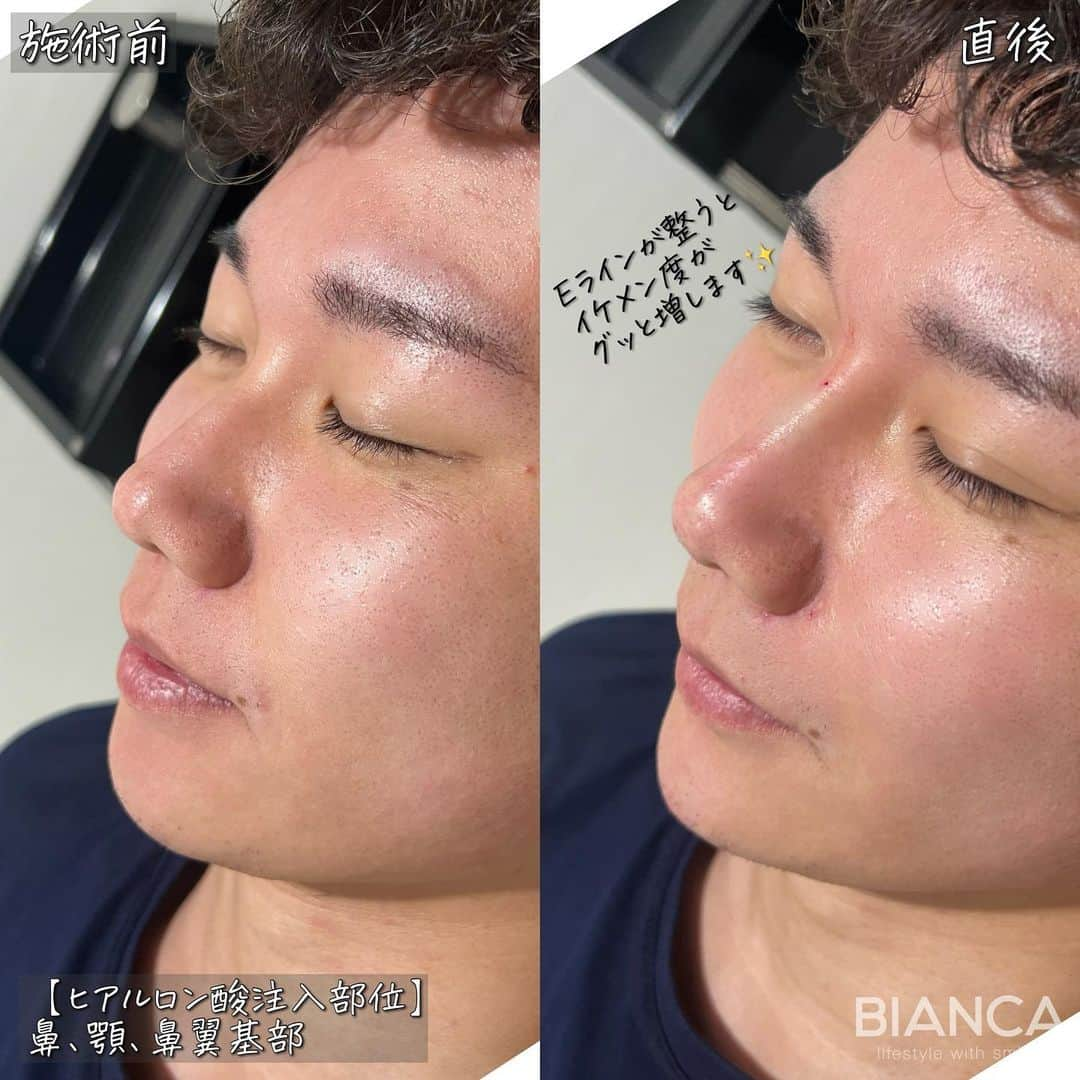 辻沢由有（BIANCA CLNIC 表参道院 院長）さんのインスタグラム写真 - (辻沢由有（BIANCA CLNIC 表参道院 院長）Instagram)「#dryuuヒアル　 【メンズもヒアルロン酸✨】  鼻、顎、鼻翼基部は横顔が整い 男性からのオーダーも多いです💉  治療時間、約10分👏 ヒアルロン酸でお顔を更に洗練🎉  どうなりたいかわからない方も こだわりがたくさんある方も 綺麗になりたい方、お任せください🥰  ✽.｡.:*・ﾟ ✽.｡.:*・ﾟ ✽.｡.:*・ﾟ ✽.｡.:*・ﾟ ✽.｡.:*・ﾟ  ✔︎鼻先〜鼻筋ヒアルロン酸 レスチレンリフト 1ml 107,800円＋税　 ✔︎顎ヒアルロン酸 ボラックス 1ml 77,000円＋税 ✔︎鼻翼基部ヒアルロン酸 ボリューマ 1ml 77,000円＋税  別途施術料　22,000円＋税  ⏳治療時間: 10分 🗓持続期間: 1〜2年 😷腫れ・内出血: 数日程度 ⚠️リスク: 感染・血流障害・凹凸など  ✽.｡.:*・ﾟ ✽.｡.:*・ﾟ ✽.｡.:*・ﾟ ✽.｡.:*・ﾟ ✽.｡.:*・ﾟ  📝ご予約はwebが便利です✨ プロフィール欄のリンクからご予約ください。 ※医師指名可能（“大久保医師指名”をクリック） ※診察料はかかりません🙅‍♀️ ※表参道院勤務が9割となっています。  📍BIANCA CLINIC ※お電話頂くと自動音声通話に繋がります。 ✔︎表参道院 ☎️05018071593 東京都港区南青山5-11-10  南青山511ビル 2F ✔︎銀座院 ☎️05031964834 東京都中央区銀座1-8-19 キラリトギンザ12F  •診療時間 10:00〜19:00 •年中無休（年末年始を除く）   ✽.｡.:*・ﾟ ✽.｡.:*・ﾟ ✽.｡.:*・ﾟ ✽.｡.:*・ﾟ ✽.｡.:*・ﾟ  #鼻ヒアルロン酸 #鼻整形 #鼻先ヒアルロン酸 #eライン #横顔美人 #ヒアルロン酸 #鼻翼基部ヒアルロン酸 #貴族ヒアルロン酸 #顎ヒアルロン酸」10月15日 13時12分 - i_am_yuu__