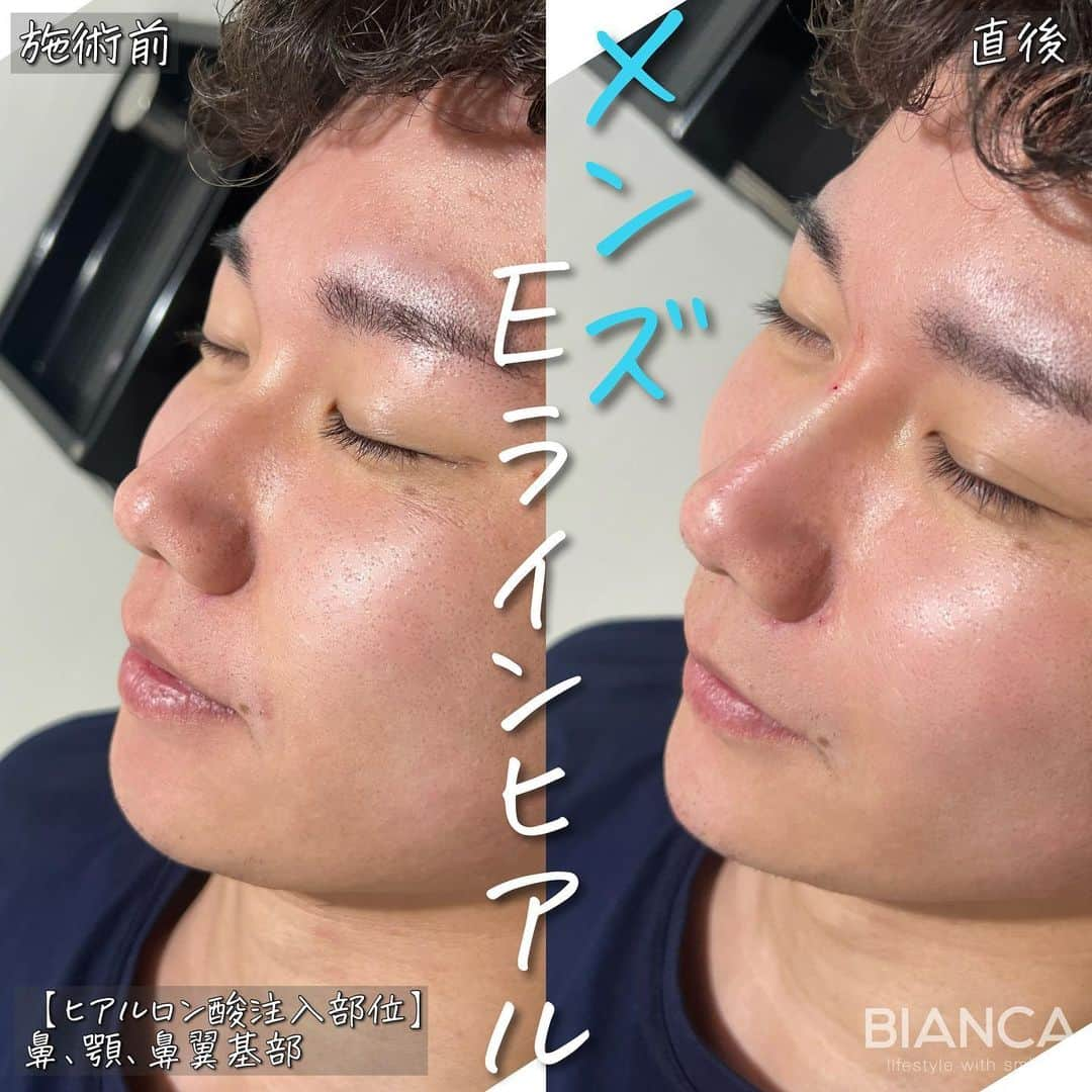 辻沢由有（BIANCA CLNIC 表参道院 院長）のインスタグラム：「#dryuuヒアル　 【メンズもヒアルロン酸✨】  鼻、顎、鼻翼基部は横顔が整い 男性からのオーダーも多いです💉  治療時間、約10分👏 ヒアルロン酸でお顔を更に洗練🎉  どうなりたいかわからない方も こだわりがたくさんある方も 綺麗になりたい方、お任せください🥰  ✽.｡.:*・ﾟ ✽.｡.:*・ﾟ ✽.｡.:*・ﾟ ✽.｡.:*・ﾟ ✽.｡.:*・ﾟ  ✔︎鼻先〜鼻筋ヒアルロン酸 レスチレンリフト 1ml 107,800円＋税　 ✔︎顎ヒアルロン酸 ボラックス 1ml 77,000円＋税 ✔︎鼻翼基部ヒアルロン酸 ボリューマ 1ml 77,000円＋税  別途施術料　22,000円＋税  ⏳治療時間: 10分 🗓持続期間: 1〜2年 😷腫れ・内出血: 数日程度 ⚠️リスク: 感染・血流障害・凹凸など  ✽.｡.:*・ﾟ ✽.｡.:*・ﾟ ✽.｡.:*・ﾟ ✽.｡.:*・ﾟ ✽.｡.:*・ﾟ  📝ご予約はwebが便利です✨ プロフィール欄のリンクからご予約ください。 ※医師指名可能（“大久保医師指名”をクリック） ※診察料はかかりません🙅‍♀️ ※表参道院勤務が9割となっています。  📍BIANCA CLINIC ※お電話頂くと自動音声通話に繋がります。 ✔︎表参道院 ☎️05018071593 東京都港区南青山5-11-10  南青山511ビル 2F ✔︎銀座院 ☎️05031964834 東京都中央区銀座1-8-19 キラリトギンザ12F  •診療時間 10:00〜19:00 •年中無休（年末年始を除く）   ✽.｡.:*・ﾟ ✽.｡.:*・ﾟ ✽.｡.:*・ﾟ ✽.｡.:*・ﾟ ✽.｡.:*・ﾟ  #鼻ヒアルロン酸 #鼻整形 #鼻先ヒアルロン酸 #eライン #横顔美人 #ヒアルロン酸 #鼻翼基部ヒアルロン酸 #貴族ヒアルロン酸 #顎ヒアルロン酸」