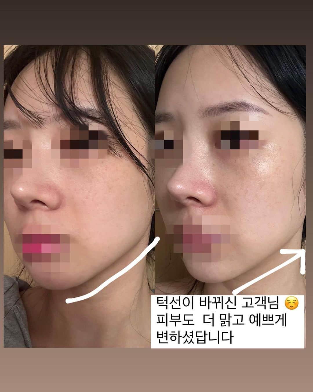 チョ・ミニョンさんのインスタグラム写真 - (チョ・ミニョンInstagram)「바르는 슈링크! 듀오 크림  𝐎𝐏𝐄𝐍 𝟴𝟴,𝟬𝟬𝟬원 > 𝟯 만 원대 𝟱𝟱% 런칭 핫딜 사은품 혜택을 가격에 다 녹여만든 𝟱𝟱%  👉🏻#필독 선 사용하신 고객님들이 후기   사용후 5일부터~1주일 최대 3주안에 모두 효과 보셔서 보내주신 후기들 이세요 ( 본사 임상은 4주 였은데, 저희 고객님들 3주안에 결판이 났네요😃  보통 며칠 안에 리프팅 된 탱탱해진 피부 안색과 맑고 청초해진게 보이고 1주일 지나면 모공이 점점 작아지는게 보이면서 얼굴이 점점 싹 올라 붙어지는 얄쌍해지는게 보이시고 2-3주 지나면 팔자 주름부터 결자체가 바뀐게 막눈이여도 보일 정도라구요 🤭  저만 느낀 착각에, 뇌피셜이아닌 함께 사용하신 고객분들하고 소통하면 알려주신 내용이랍니다 ^^  자 원래대로의 본사 *4주 사용 기준 임상이* -꺼진볼 피부탄력 개선 -처진 볼(불독살) 리프팅 개선 -국소(팔자)부위 주름 개선 -피부 보습력 개선 -모공 볼륨 개선 -모공 개수 개선 -모공 면적 개선 -모공 최대 깊이 개선 -피부 치밀도 개선  *개인 피부특성에 따라 차이가 있을 수 있음 *핑크스피큘크림, 밀크엑소좀크림 병행사용 결과인데  저희 테스터 분들은 모두 3주안에 효과를 보신 점 참고해주시고  거진 3+1 재구매 하시다고 지금 대기 타고 계신답니다 ⭐️ 자 어서 달려오세요-!」10月16日 11時32分 - xxjominxx