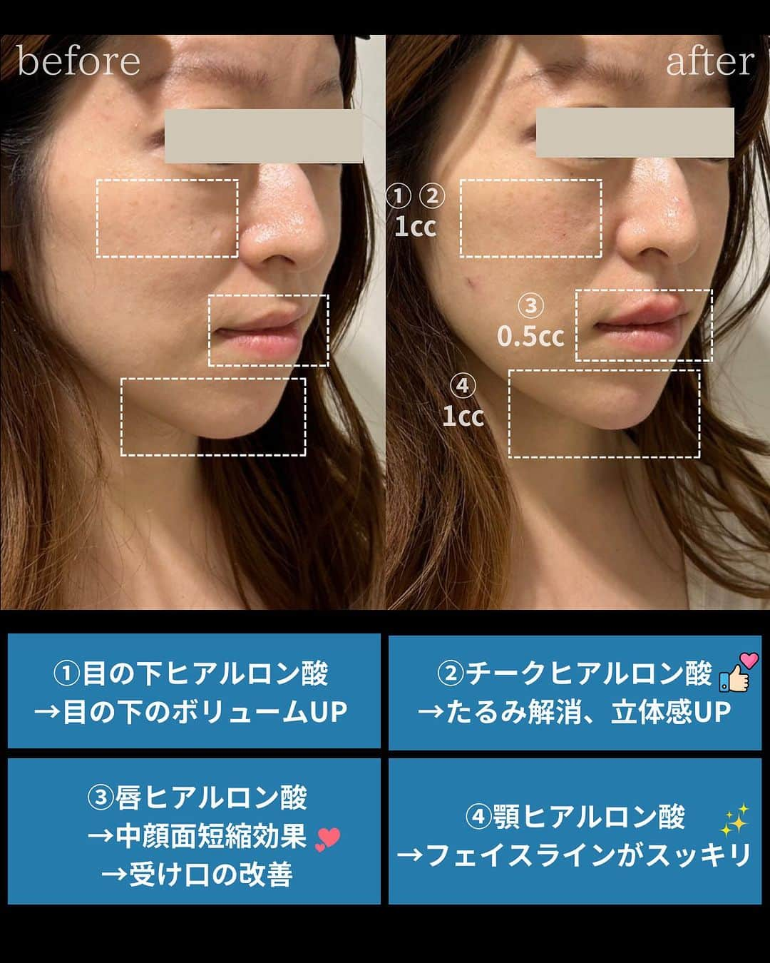 恵比寿フィラークリニックさんのインスタグラム写真 - (恵比寿フィラークリニックInstagram)「ヒアルロン酸カスタマイズしてみた🤩 バレずに自然な垢抜け効果🙆🏻‍♀️  「可愛く」と言うと涙袋やスマイルリップをするイメージですが 頬に高さを出したり、パーツの位置を視覚的に調節するように注入する事で 顔全体で見ると「可愛くなった」印象になります😉✨  #フィラークリニック #垢抜け #垢抜ける方法 #垢抜けたい #顎ヒアルロン酸 #唇ヒアルロン酸 #可愛くなりたい #可愛くなる方法 #チーク #立体感 #立体感メイク #中顔面短縮 #たるみ改善 #たるみケア #たるみ」10月16日 18時48分 - filler_clinic