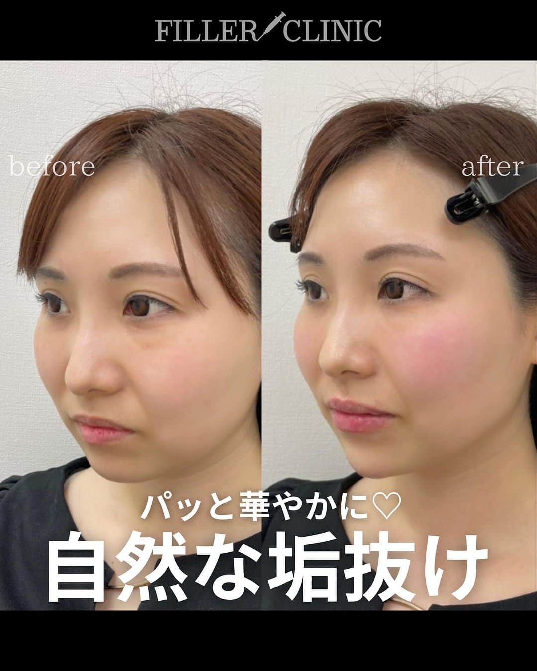恵比寿フィラークリニックさんのインスタグラム写真 - (恵比寿フィラークリニックInstagram)「ヒアルロン酸カスタマイズしてみた🤩 バレずに自然な垢抜け効果🙆🏻‍♀️  「可愛く」と言うと涙袋やスマイルリップをするイメージですが 頬に高さを出したり、パーツの位置を視覚的に調節するように注入する事で 顔全体で見ると「可愛くなった」印象になります😉✨  #フィラークリニック #垢抜け #垢抜ける方法 #垢抜けたい #顎ヒアルロン酸 #唇ヒアルロン酸 #可愛くなりたい #可愛くなる方法 #チーク #立体感 #立体感メイク #中顔面短縮 #たるみ改善 #たるみケア #たるみ」10月16日 18時48分 - filler_clinic