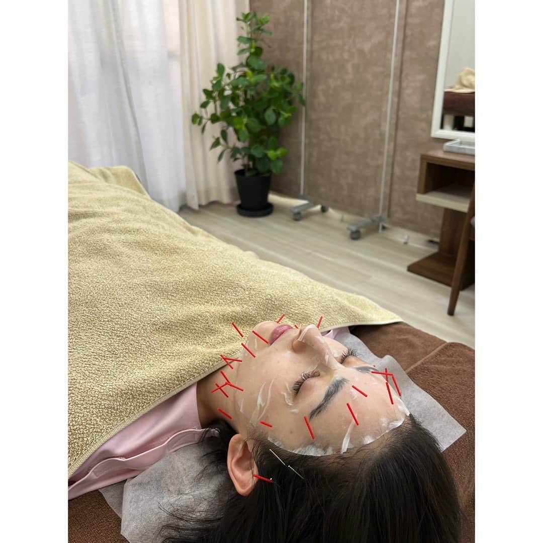 早見あかりのインスタグラム：「_ ⁡ 莉麻に紹介してもらって 石井治療院に行かせてもらいました！ ⁡ 刺絡カッピングに美容鍼で からだは楽に顔はしゅっと ⁡ そしてなによりくすみが飛んだーー ⁡ ビフォアフすごいからみて 髪ボッサだしみせるものじゃないかもだけど ⁡ よきものはシェア！！！！！！ ⁡ ⁡ #PR#石井治療院」