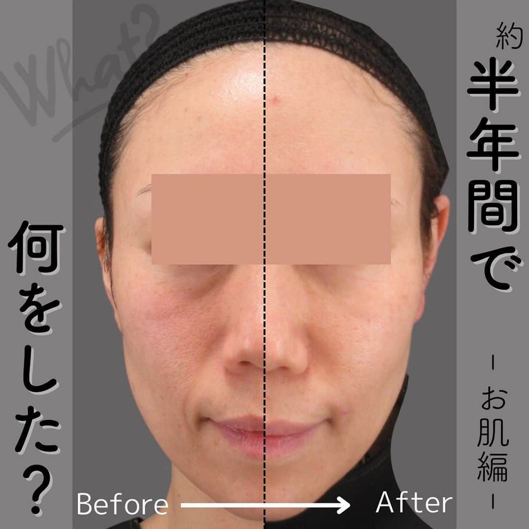 YAG BEAUTY CLINICのインスタグラム：「#Repost @yag_beauty_clinic_fukuokain ・・・ 🫧 🫧 当院でリピート率の高い“水光注射”💉 痛いけど、ダウンタイムはあるけど それでも定期的にしたくなる施術なんです  こちらのモニター様は約半年の間で 水光注射を6回されています。  1-2回目：スタンダード+ヒアルロン酸 3-6回目：HSCM+サーモン  季節や肌状態、お悩みに合わせて 薬剤をチョイスできるのも 水光注射の魅力なんです🏹♡  また、水光注射は針の深さも細かく調節ができるので 毛穴やクレーターの気になる部分には 深く、そして重ねて注入していきます。  そうすることで針の刺激による創傷治癒効果🩹 (肌を傷付ける事で新しい細胞が作られ、 コラーゲンやエラスチンが増加しハリ感upする効果)と、 薬剤による効果💉がそれぞれ発揮され お肌悩みを改善していくというわけです。💡  毛穴や乾燥、肌質改善…etc.にピッタリな水光注射 当院スタッフも大好きで、月1で受けています。 これをすると調子が良いんです🥺 つやピカのフカフカ肌…☁️ 他の施術では得られない唯一無二の質感が得られます。 思わずずっと触ってしまいます。  ただ、これはどの肌治療でも言えることですが 一回で充分な効果を実感することはできません。 地道に、だけど確実に。 これが肌治療のオキテです🥺  まずは月1ペースで6回を目安に していただきたいですね😌♡  ･何の薬剤が合うかわからない ･いつまでに綺麗にしたい ･ご予算　…etc なんでもご相談ください。  おひとりおひとりに合う薬剤を オーダーメイド致します🤍🦄  Yag Beauty Clinic 福岡」