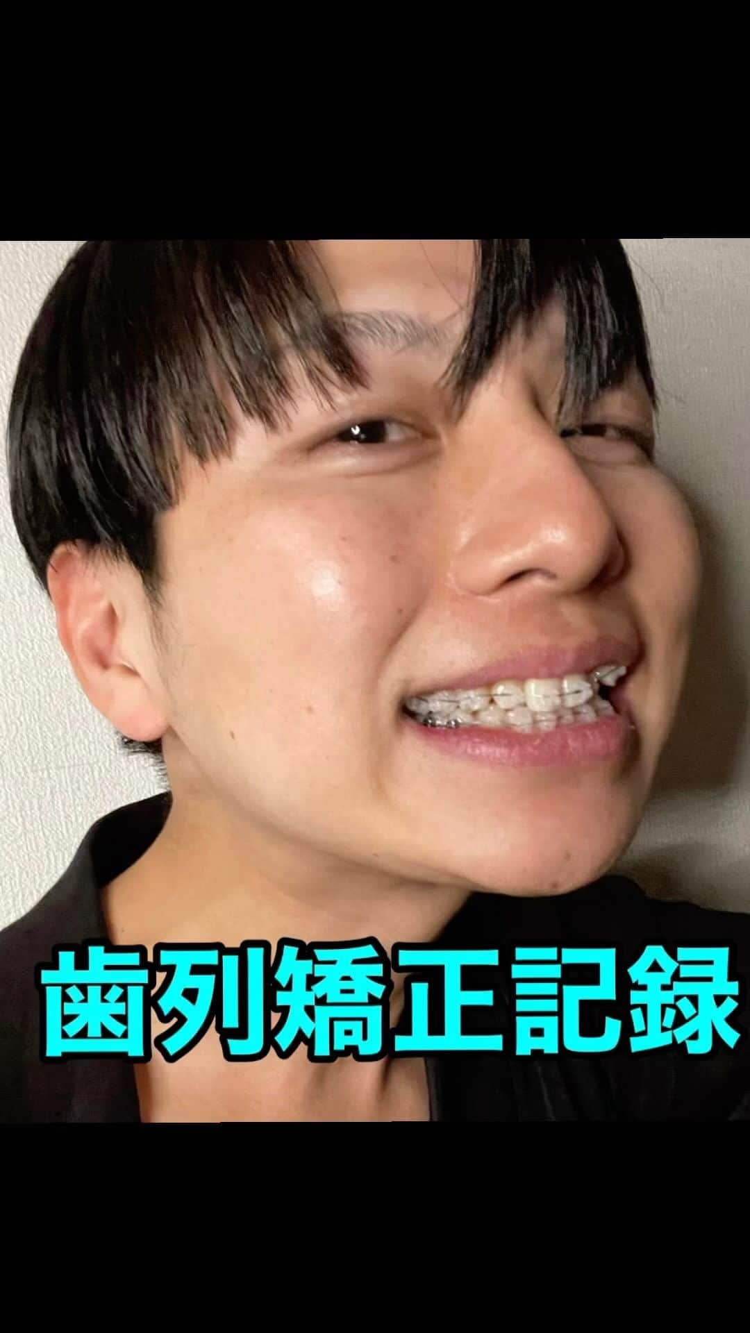 瀬戸口弘樹のインスタグラム：「Hello beauty🩵🫧✨ 2年5ヶ月歯列矯正を終えました🦷🫧✨ 歯の動きを途中まで写真に残していたのでリールに残したいと思います🩵🫧✨ こんなに綺麗になるなんて本当にびっくりbeautyですが、この世界にはこうやって整えてくださる人がいるって事を皆さんに知って頂けたら嬉しいです🩵🫧✨  人って全てを整える事で本来なる姿にもどっていくんだなって改めて思いました☺️🫧✨  整える、人もこの地球も🌏🫧✨  #歯列矯正　#ワイヤー矯正　#矯正　#歯並び　#赤坂ヴィーナスデンタルクリニック　#瀬戸口弘樹　#バチェロレッテ  #バチェラー　#美容男子　#日傘男子　#日傘のお兄さん　#糀prince #整える　#美容　#健康　#幸せ　#happy #幸福 #自信　#本来の自分　#beauty #japan #dental #dentalclinic」