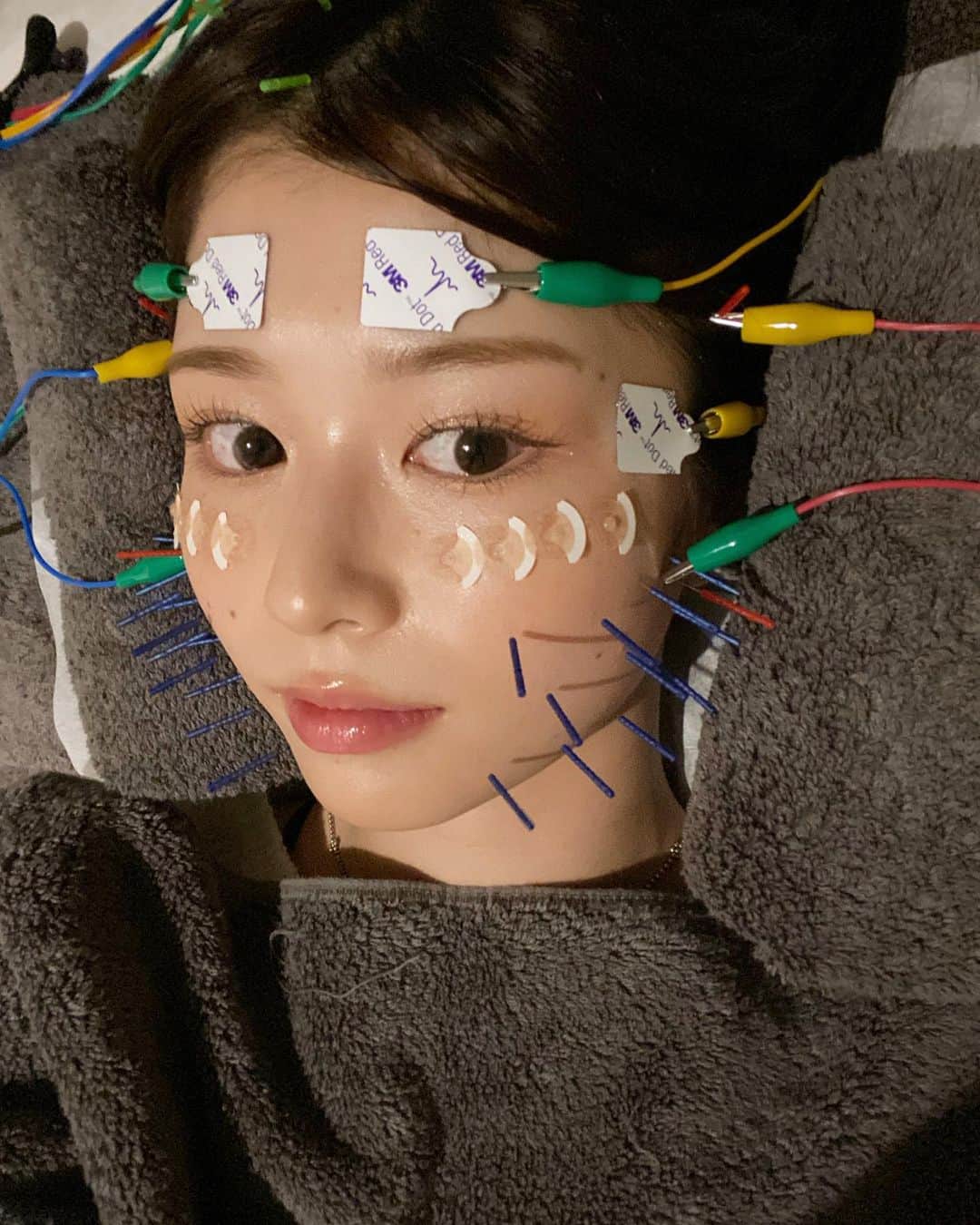 冴木柚葉のインスタグラム：「. 撮影前に駆け込みで人生初の美容鍼行ってきました😳 見た目凄いことになってるけど、めっちゃ気持ちよかった🤤  撮影の2日前だったので内出血のリスクを最小限に抑えれるよう 通常よりもさらに細い鍼を使う 【ウエディングコース】 にしてもらいました！（勿論結婚はしませんが！笑）  エラやこめかみ等の凝ってるところは 刺す時にずーんっと重たい感じがするんだけど、 20秒くらいですーっと重みが消えて気持ちよくなるの！ 正直鍼って痛そうで避けてたんだけどイメージ変わった🫣  浮腫もすっかりなくなってフェイスラインがくっきり出たし、 肌ツヤも出てほんとにやってよかった🤍 手放せない美容になりそう…💭  わたしの投稿を見てご予約された方は通常18,000円のところ、 美容鍼60分コースが初回限定で10,000円… のところ、さらにお得に9,000円で受けられます✨ 気になってる方は是非！！  サロンは　@quinbelle_omotesando さんにお願いしました！」
