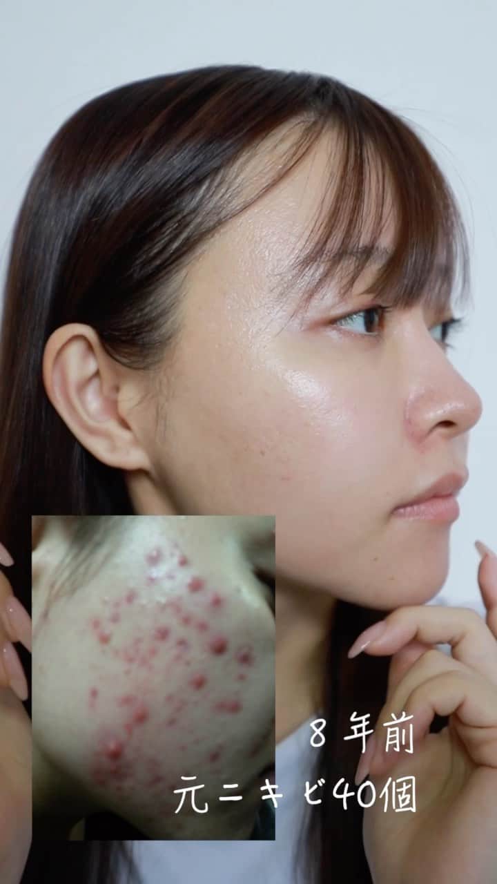 歩乃華（ほのらん）のインスタグラム：「ポテンツァしてきました🥰 ダウンタイムも少なくてめっちゃツルツル😻  【歩乃華の投稿見た】 で30%オフになるので 是非行ってみて下さい😍  @tclinic_sagara  相良先生ありがとうございました🥹⭐️  @tclinic_shinjuku #pr」
