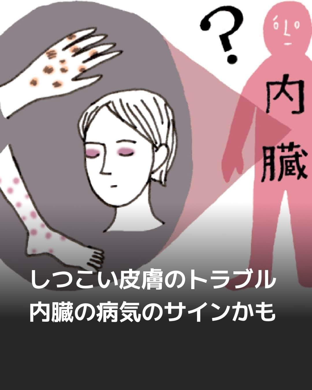 日本経済新聞社さんのインスタグラム写真 - (日本経済新聞社Instagram)「「皮膚は内臓を映し出す鏡」との諺（ことわざ）があります。皮膚に現れる症状が内臓疾患を示唆することは少なくありません。その一例が「デルマドローム」で、皮膚が示す内臓の変化のサインのこと。治りが悪い湿疹が実は内臓の病気が原因であったということは珍しくありません。⁠ ⁠ 詳細はプロフィールの linkin.bio/nikkei をタップ。⁠ 投稿一覧からコンテンツをご覧になれます。⁠→⁠@nikkei⁠ ⁠ #皮膚 #ケア #内臓 #病気 #かゆい #日経電子版」10月19日 22時00分 - nikkei