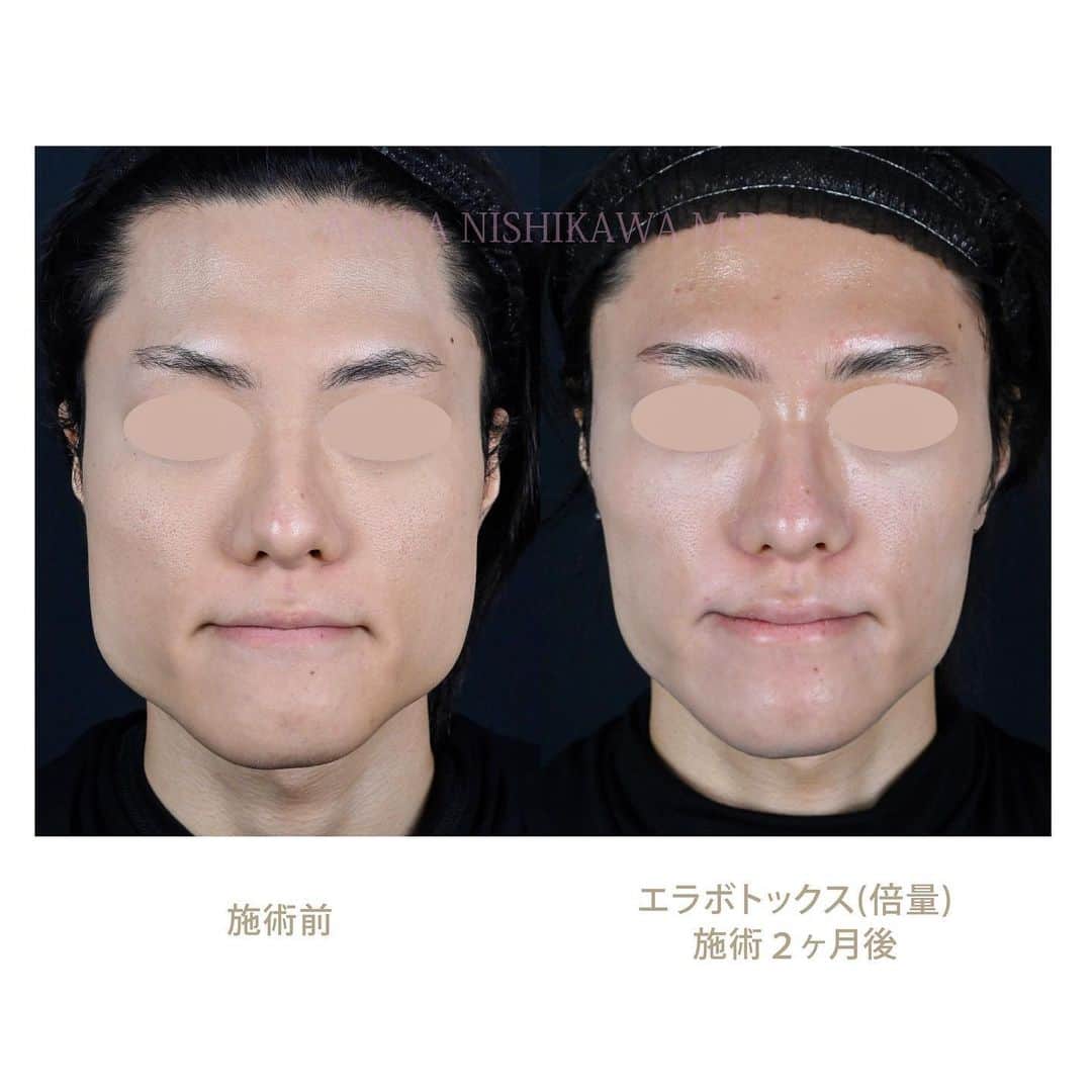 西川礼華のインスタグラム：「咬筋へのA型ボツリヌス毒素（ボトックス）注入は、エラが張っている四角い輪郭を手軽に小顔にすることができる治療です。 こちらのモニター様は、咬筋へボトックスを片側40単位ずつ投与しました。当院ではエラボトックス倍量というメニューに該当します。術後すぐに効果は発現せず、1~2ヶ月ほどかけて徐々に咬筋が萎縮して小顔になります。 投稿した写真の1枚目が噛み締め時のビフォーアフター、投稿した写真の2枚目が無表情の時のビフォーアフターです。 1回の施術でも効果が分かりやすいので、エラボトックスはコスパの良い治療だなと思います。また、「エラボトックスをして頬がコケる」「エラボトックスをしてタルミが悪化する」というリスクもたしかにありますが、適応と投与方法を正しく見極めれば、ご覧のとおり美しい結果を得ることもできます。  Botulinum Toxin (Botox) injection into the masseter muscles is a convenient treatment to achieve a more refined face by reducing the square jawline. In this case, this patient received 40 units of Botox on each side of the masseter muscles. The results aren't immediate; it takes about 1-2 months for the masseter muscles to gradually atrophy, leading to a slimmer face. The first photo shows the before and after results when clenching the jaw, and the second photo demonstrates the before and after results at rest. Even with just one session, the results are noticeable, making it a cost-effective treatment. While there are risks associated with this procedure, such as cheek sagging or worsened sagging, beautiful results are achievable with proper assessment and administration. #Botox #massetermuscle #BeforeAndAfter #BeautyResults  ▼価格 エラボトックス(倍量/80単位) :37,600円(税込)  ▼施術説明 施術名：エラボトックス 施術の説明：エラの筋肉に注射し、筋肉の動きを多少麻痺させることにより筋肉を細くする治療です。 施術の副作用（リスク）：疼痛・腫れ・内出血・アレルギー・表情に違和感を生じる可能性があります。  #エラボトックス #ボトックス #小顔治療 #湘南美容クリニック #ayakanishikawa #西川礼華」