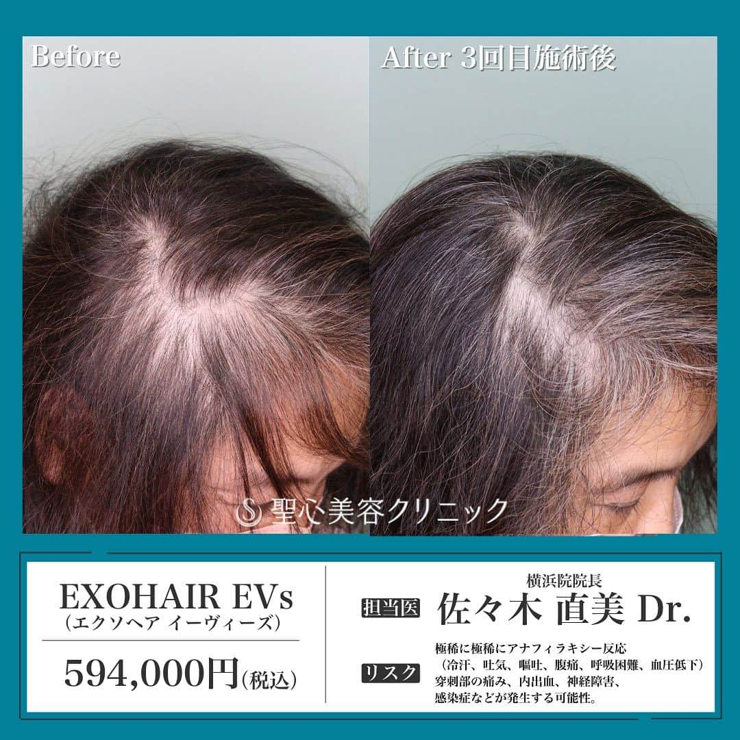 聖心美容クリニック公式アカウント のインスタグラム：「. ＼【60代女性・薄毛】EXOHAIR EVs（4回処置後2か月）✨／  60代女性です。 beforeでは分け目を中心に頭皮の透けが目立っていました。  afterは4回処置後2か月になります！ 術後は頭皮の透ける範囲が狭くなりましたね💓  EXOHAIR EVsはエクソソームを用いた毛髪再生処置です。 現時点、モニター様の症例をみると2週間間隔2回処置後と、 これまで行っていた成長因子による毛髪再生より早い段階で効果が見えている傾向です！  症例紹介アカウント（ @seishin_beforeafter ）で他の症例もチェックしてみてくださいね💕  一人ひとりのご希望に寄り添う丁寧なカウンセリング🏥 あなたの悩みに最適なオンリーワンの施術を🌷 聖心美容クリニックの無料カウンセリングは下記からお気軽にご連絡ください✨  ･+････+････+････+･･ 📲WEB予約：プロフィールからリンクをクリック　@seishinbiyou 📞電話予約：0120-112-614 🍀LINE予約：「聖心美容クリニック」で検索 ･+････+････+････+･･  ---------------------------  👨‍⚕️担当医 横浜院院長 佐々木 直美( @seishin_sasaki )  💉施術名 EXOHAIR EVs（エクソヘア イーヴィーズ）  🌱施術内容  毛髪治療用薬剤「EXOHAIR Evs（エクソヘア イーヴィーズ）」を頭皮へ注入。【成分】エクソソーム  ⚠️リスク・副作用  極稀に極稀にアナフィラキシー反応（冷汗、吐気、嘔吐、腹痛、呼吸困難、血圧低下）、穿刺部の痛み、内出血、神経障害、感染症などが発生する可能性。  💰費用 594,000円（税込）  ---------------------------  #薄毛 #薄毛治療 #EXOHAIR  #エクソヘア #エクソソーム #再生治療 #毛髪再生治療  #美容クリニック  #美容整形  #美容医療  #美容皮膚科  #とことん真面目に美容医療  #聖心美容クリニック #聖心美容クリニック横浜院」