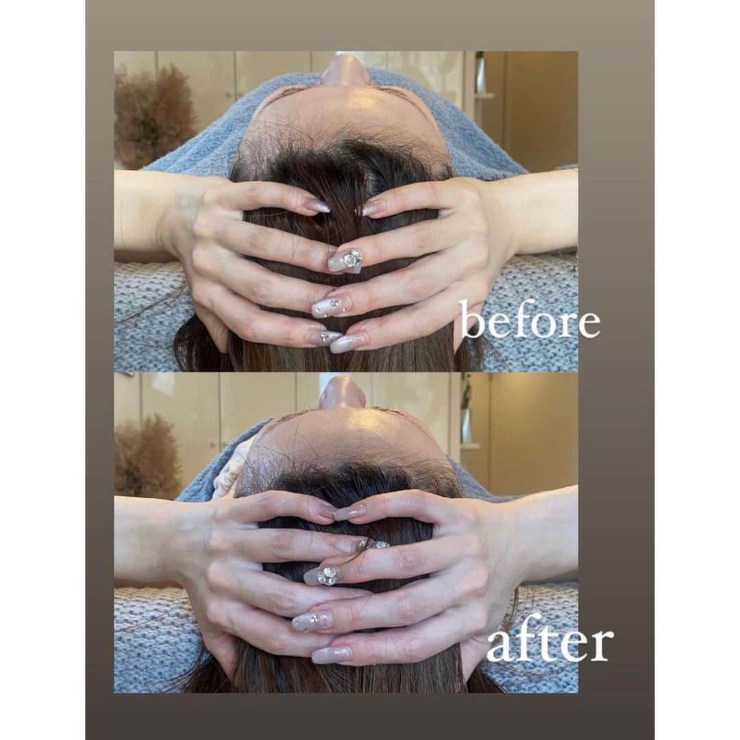 駒井まちさんのインスタグラム写真 - (駒井まちInstagram)「長いお付き合いになるさきえさんのサロン S.beautysalon(@s.beauty.salon701 )へ🪞🫧  さきえさんが超小顔で説得力しかないので ドライヘッドスパ＋小顔矯正＋デコルテリンパのコースでお願いしました💆🏻‍♀️  根本から改善を目指した施術で 自分の悩み(歪みや痛みなど)が何故起きてるのかを 丁寧に説明して頂いてから 90分しっかり施術して頂き(もはや治療☝️) ホームケアのアドバイスも🪄 鏡を見て気になる顔の歪みが整ったのはもちろん、 肩周りが本当にすっきりして身体の重さも取れました😭💫  ホットペッパーにもお得なクーポンが 記載されているので是非チェックしてみてください☺️🌿  #フェイシャル #フェイシャルエステ #エステ #エステサロン #デコルテ #デコルテリンパ  #マッサージ #ヘッドスパ #ドライヘッドスパ #ドライヘッドマッサージ #小顔矯正 #大阪 #本町 #新町 #osaka #beauty」10月22日 23時33分 - _komaimachi_