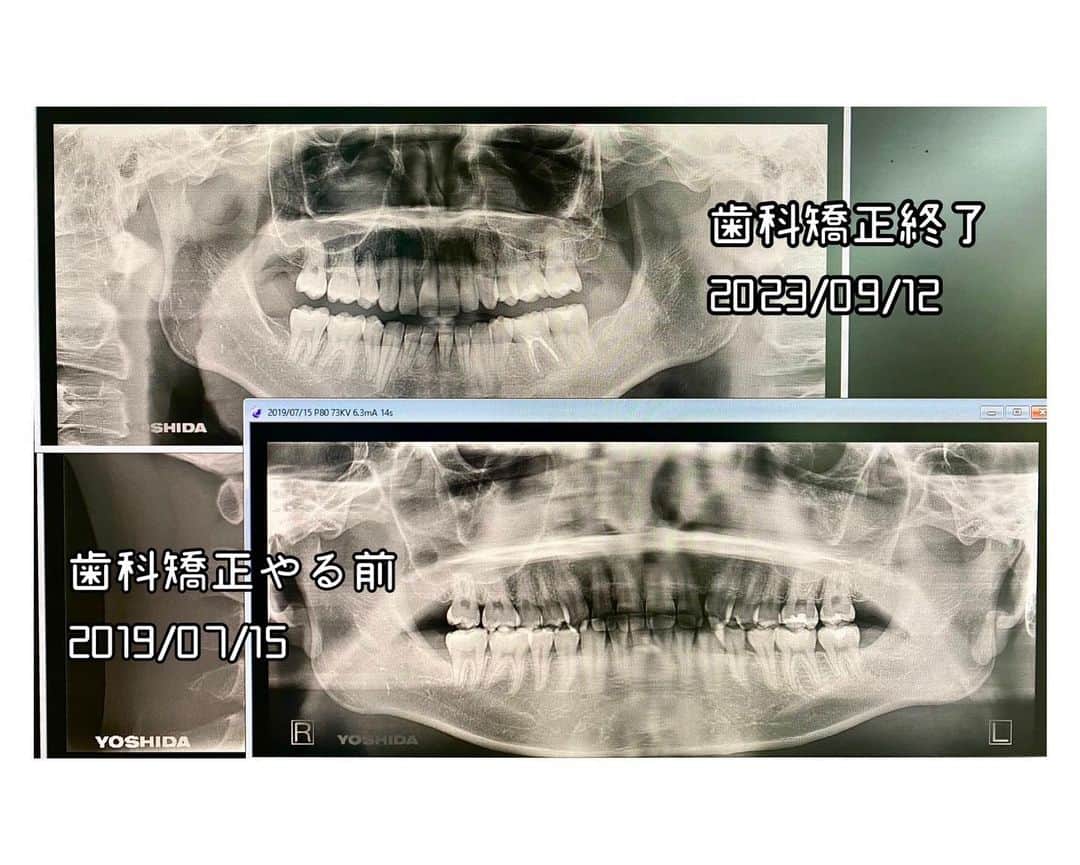 江崎びす子さんのインスタグラム写真 - (江崎びす子Instagram)「歯科矯正の担当医からビフォーアフターの写真もらってきたヨ〜(´・∀・｀)✨  4年間頑張った甲斐があった♪  #歯科矯正」10月24日 21時20分 - bisukoezaki