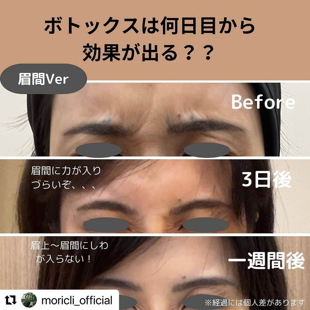 宋美玄のインスタグラム：「#Repost @moricli_official with @use.repost ・・・ ボトックス注射後、2〜3日後からシワが減った実感がありました。  注射にはやはりお痛みがありますが、 効果が短期間で分かりやすく、満足度の高い施術だと思います😊  もっと知りたい▶︎ @moricli_official   ◾️ボトックス 当院では皆さまに安心して治療をお受けいただくため、製剤の品質にこだわっております。厚生労働省承認のアラガン社のボトックスのみを使用しています。 ⁡ ⁡ 【金額】 眉間 ▶27,500円（税込） 目尻 ▶27,500円（税込）  【所要時間】 15分＋カウンセリング60分 当院では女性のお悩みにトータルアプローチすることを目標に掲げ、医師×看護師のWカウンセリングを行っています。そのためカウンセリングのお時間を長めにお取りしております。ご了承いただけますと幸いでございます。  【回数・間隔】 3ヶ月おき  【リスク】 感染症、アレルギー  【ダウンタイム】 腫れ、内出血、むくみ、お痛み （2週間程度）  ▶︎経過 施術2〜3日後〜1週間：徐々にボトックスが効いてきます。 2〜3ヶ月程度で徐々に効果が薄れていきます。  ▶︎洗顔・メイク・シャワー：当日から可 ▶︎マッサージ・運動・長時間の入浴：1週間以上控える （ボトックスが熱に弱く、効果減弱する可能性があるため）  ご予約はプロフィール欄URLからご案内可能です！ @moricli_official  ＿＿＿＿＿＿＿＿＿＿＿＿＿＿＿＿＿＿＿＿＿＿＿＿＿ #レディースクリニック #産婦人科 #婦人科検診 #ピル #緊急避妊薬 #アフターピル #30代美容 #40代美容 #美容皮膚科 #美容クリニック #美容 #スキンケア  #ニキビ #にきび #ニキビ跡 ＃老け顔#アンチエイジング #毛穴 #シミ #シワ #たるみ ＃老け顔 #ルメッカ #ウルトラセルzi #ハイフ #東京美容皮膚科 #丸の内美容皮膚科 #東京 #丸の内 #銀座」