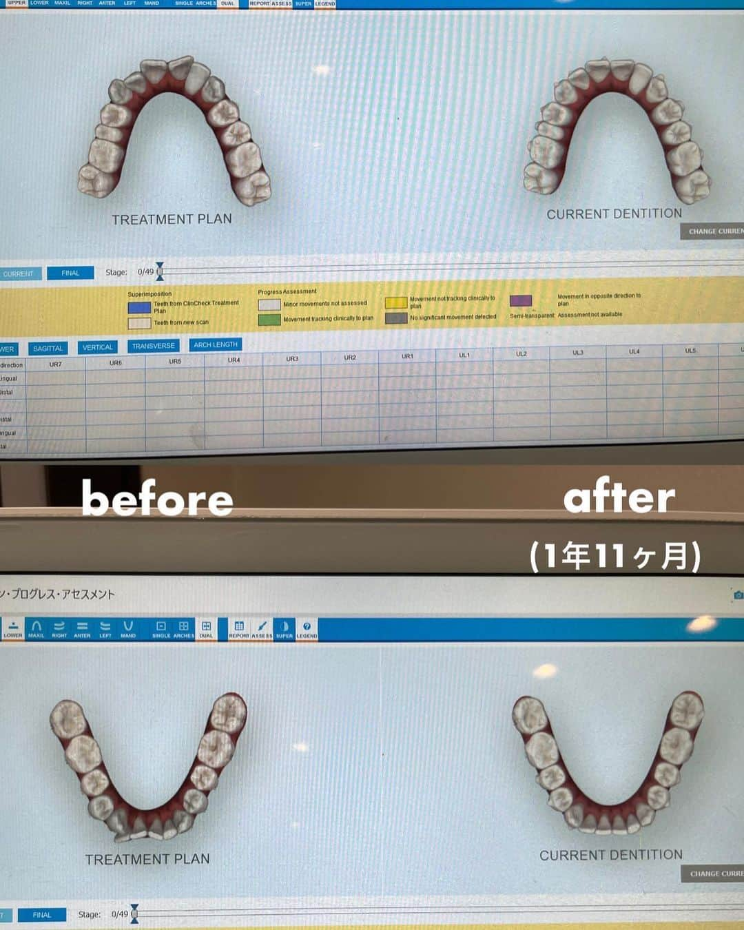 yan___5さんのインスタグラム写真 - (yan___5Instagram)「歯科矯正🦷1クール終了しました！ @eternal_dental_clinic  ですが、まだ少し気になったので 2クール目に入りました。 2クール目は16ピース✌️  橋正を始めて、12月末で丸2年が経ちます🕛 マウスピース生活には慣れて 周りの人たちにもキレイになったね！と言ってもらえて 本当にやってよかった🥹♡  なにより、歯磨きがしやすくなったよ🪥🫧 アタッチメントがついてるけど前よりは断然！  #yan_矯正日記  #インビザライン矯正記録」11月21日 19時18分 - yan___5