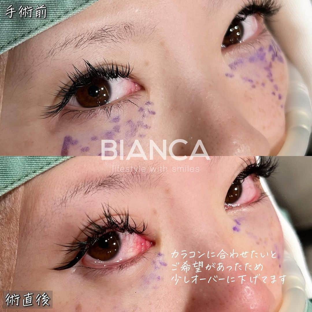 辻沢由有（BIANCA CLNIC 表参道院 院長）さんのインスタグラム写真 - (辻沢由有（BIANCA CLNIC 表参道院 院長）Instagram)「#dryuu目 グラマラスライン形成💞  グラマラスラインで自然な目元のカーブと大きさを形成しました✨  あくまでわざとらしくなく、ぱっと見の印象も プラスに変化しましたね🥰❤️  ▶︎価格 ✔︎グラマラスライン形成（下眼瞼下制術） 　382,800円＋税 ▶︎ダウンタイム 　腫れ 内出血:数日〜1週間程度  ✽.｡.:*・ﾟ ✽.｡.:*・ﾟ ✽.｡.:*・ﾟ ✽.｡.:*・ﾟ ✽.｡.:*・ﾟ  📝ご予約はwebが便利です✨ プロフィール欄のリンクからご予約ください。 ※医師指名可能（“大久保医師指名”をクリック） ※診察料はかかりません🙅‍♀️ ※表参道院勤務が9割となっています。  📍BIANCA CLINIC ※お電話頂くと自動音声通話に繋がります。 ✔︎表参道院 ☎️05018071593 東京都港区南青山5-11-10  南青山511ビル 2F ✔︎銀座院 ☎️05031964834 東京都中央区銀座1-8-19 キラリトギンザ12F  •診療時間 10:00〜19:00 •年中無休（年末年始を除く）   ✽.｡.:*・ﾟ ✽.｡.:*・ﾟ ✽.｡.:*・ﾟ ✽.｡.:*・ﾟ ✽.｡.:*・  #グラマラスライン#グラマラスライン形成 #タレ目#タレ目形成」11月21日 14時45分 - i_am_yuu__