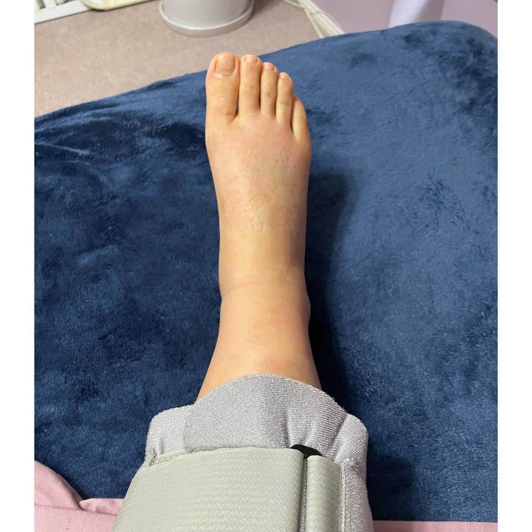 水沢史絵のインスタグラム：「浮腫がとれてきた！ パツパツむくみからのbefore after すごいね人体👏   #半月板縫合手術」