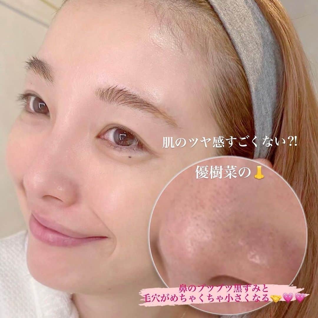 木下優樹菜さんのインスタグラム写真 - (木下優樹菜Instagram)「優樹菜が自信をもっておすすめしたい💗 スキンケア愛用品🎀 ずっと毛穴のひらきと黒いポツポツ気になってて💦 そんな毛穴悩みを解決してくれるアイテム🫡 “奇跡の万能薬”🌿って言われてる タマヌオイルとか貴重な高級成分をたっぷり配合✨なのに、リーズナブルなの❤️‍🔥 口コミから大人気で、今入手困難なんだけど😭💦 今回特別に、500件だけ優樹菜のフォロワーさんにスペシャル価格実現できました🥹🤝❤️‍🔥❤️‍🔥 しかも優樹菜限定プレゼント付き🎁  ⚠️クーポンはストーリーに貼ってあるよ❤️‍🔥 　@yukina1204xoxo ↑ここからストーリー見てみてね🤝💓 先着順500名限定です🫡  #pr」10月30日 20時02分 - yukina1204xoxo