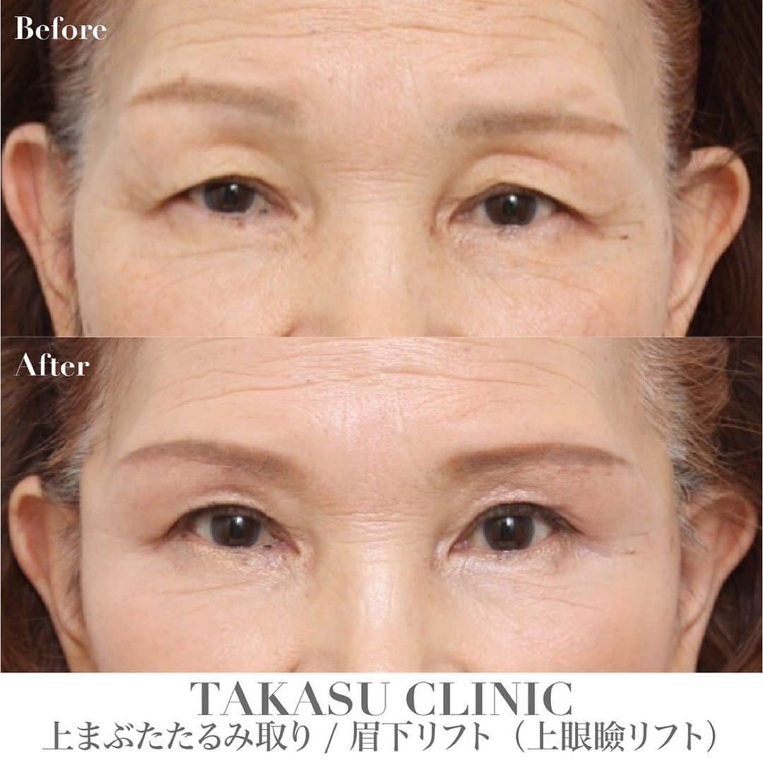 高須クリニック名古屋院のインスタグラム：「#repost @takasumikiya via @PhotoAroundApp  眉下での上まぶたたるみ取り（眉下リフト）の症例写真  上まぶたたるみ取り / 眉下リフト（上眼瞼リフト）  この方は、もともと二重まぶただったのですが、加齢により額、コメカミから上まぶたにかけて皮膚が下垂し、二重のラインがかくれてしまい、三角の老けた目になっていました。 こういうタイプの方は、二重のラインで皮膚のたるみを切除してしまうと、上の方の厚ぼったい皮膚で二重がつくられることになるので、自然できれいな二重にはなりにくいです。 この方自身、あまり大きな変化は望まず、少し皮膚のたるみが上に挙がって、もともと若いころにあった狭い二重を出して、自然な目にしてほしいということだったので、眉毛の下で皮膚のたるみを切除する眉下リフトを選択しました。 術後は、自然な二重になりました。 眉毛の下の傷はほとんど分からなくなってしまいますので心配ありません。  【施術料金】 ●眉下リフト（上眼瞼リフト）	 ・片目 ¥192,500（税込） ・両目 ¥385,000（税込） 【銀座高須クリニック、横浜院、名古屋院、大阪院】  【リスク・副作用・合併症】 内出血（術後）  仕上がりの左右差（片目ずつ手術をする場合）  仕上がりのわずかな左右差（完璧なシンメトリーは不可）  仕上がりが完璧に自分の理想の形にならないことがある  【ご予約・お問い合わせ】 名古屋院☎︎ 052-564-1187 名古屋院📱 @takasuclinic_nagoya ↑名古屋院インスタのプロフィール画面からも直接コンタクトが取れます📲 https://www.takasu.co.jp/ ⁡ #高須クリニック #高須クリニック名古屋院 #高須幹弥 #高須英津子 #美容整形 #整形 #二重 #埋没法 #二重切開 #たるみ #平行二重 #末広二重 #眉下リフト #上まぶたたるみ取り #眉下リフト#症例写真 #ビフォーアフター」