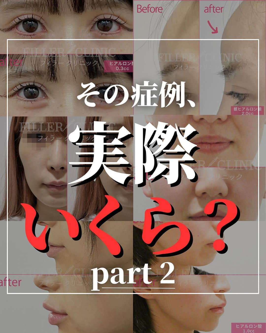 恵比寿フィラークリニックのインスタグラム：「その症例、実際いくら？ 薬剤・量、全部暴露💣part 2 ------------------- 《料金・詳細付き症例の受け取り方法》 ①この投稿を保存 ②気になる番号をコメントする ------------------- ※1つずつコメントしてください～😭 たったこれだけで自動でDMが届きます📨  #cカールリップ #涙袋ヒアルロン酸 #口角ボトックス #頬コケ #頬こけ #ほうれい線 #法令線 #ほうれい線改善 #ほうれい線ケア #老け見え #ボトックス #ヒアルロン酸 #おでこ #おでこのシワ #額ヒアルロン酸 #スマイルリップ #唇ヒアルロン酸 #美容 #美容好き #美容好きな人と繋がりたい #渋谷 #福岡 #天神 #心斎橋 #梅田 #札幌 #名古屋 #新宿 #町田 #錦糸町」