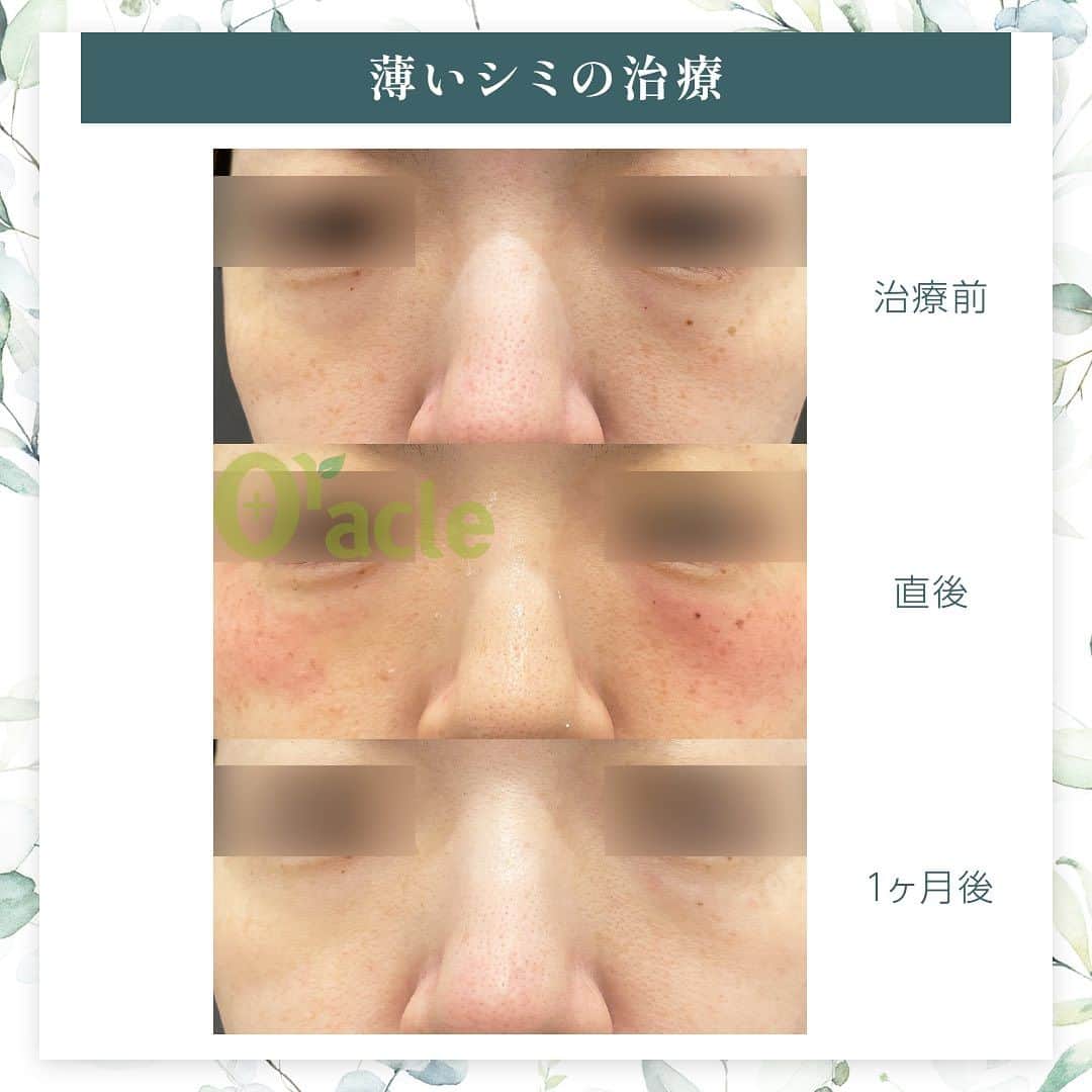オラクル美容皮膚科東京新宿院さんのインスタグラム写真 - (オラクル美容皮膚科東京新宿院Instagram)「◤薄いシミの治療◢| 《治療内容》10PL 1回目 他のレーザーで反応が見られなかった薄いシミに反応し改善が見られます。 2枚目は直後の赤みです 赤みが強く出た場合は2-3日続きます。  ☑️10PL 韓国Oracle統括院長　ノ・ヨンウ医師開発 世界初の技術『フラクショナルIPL』搭載 ➡︎特許取得  安全性 ・韓国MFDS承認機器 ・アメリカFDA承認機器  治療目的：シミそばかすの除去、肌の再生  【ダウンタイム】 赤み：3〜5日 瘡蓋：7〜10日　※テープ保護不要 洗顔：当日 メイク：当日から可能ですが、ひりつきが出ますので翌日から推奨 ⁡ 【料金】 1回38,500円税込（鎮静管理込み）  ※目周りを除く  🉐初回セット 初回セット35,000円税込（鎮静管理込み） オプション：目周り8,800円 ⁡ #シミ　#薄いシミ  #シミ取り　#シミ治療 #シミ取りレーザー #そばかす #10pl #フラクショナルレーザー #IPL #IPLレーザー #美肌　#美白 #美容皮膚科 #韓国美容　#韓国好きな人と繋がりたい #韓国クリニック」11月2日 19時32分 - oraclejp