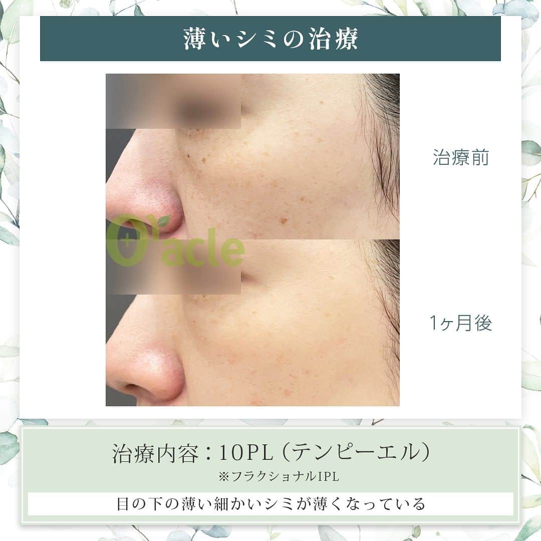 オラクル美容皮膚科東京新宿院のインスタグラム：「◤薄いシミの治療◢| 《治療内容》10PL 1回目 他のレーザーで反応が見られなかった薄いシミに反応し改善が見られます。 2枚目は直後の赤みです 赤みが強く出た場合は2-3日続きます。  ☑️10PL 韓国Oracle統括院長　ノ・ヨンウ医師開発 世界初の技術『フラクショナルIPL』搭載 ➡︎特許取得  安全性 ・韓国MFDS承認機器 ・アメリカFDA承認機器  治療目的：シミそばかすの除去、肌の再生  【ダウンタイム】 赤み：3〜5日 瘡蓋：7〜10日　※テープ保護不要 洗顔：当日 メイク：当日から可能ですが、ひりつきが出ますので翌日から推奨 ⁡ 【料金】 1回38,500円税込（鎮静管理込み）  ※目周りを除く  🉐初回セット 初回セット35,000円税込（鎮静管理込み） オプション：目周り8,800円 ⁡ #シミ　#薄いシミ  #シミ取り　#シミ治療 #シミ取りレーザー #そばかす #10pl #フラクショナルレーザー #IPL #IPLレーザー #美肌　#美白 #美容皮膚科 #韓国美容　#韓国好きな人と繋がりたい #韓国クリニック」