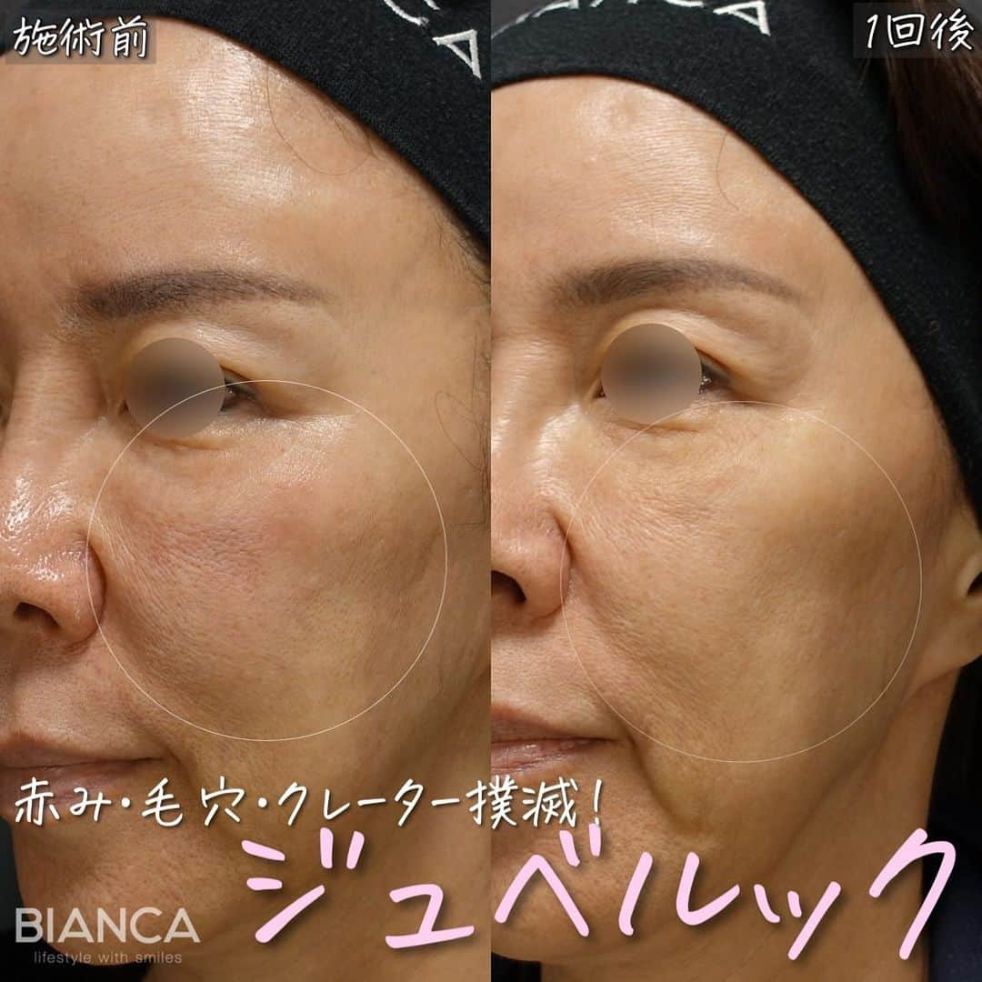 辻沢由有（BIANCA CLNIC 表参道院 院長）のインスタグラム：「最新スキンブースター✨ジュベルック💉  左:施術前 右:施術1回後  💡ジュベルック（Juvelook）とは…  PDLLA（ポリDL乳酸）による肌再生スキンブースター。 ジュベルックは非架橋ヒアルロン酸を混ぜる 注入剤で真皮層へ注入することで、コラーゲン生成を促し、肌内部を持ち上げて毛穴の開き、しわ、ニキビ跡を 目立たなくするなどの肌再生スキンブースター効果が 期待できる注入治療です。  くぼみの改善だけでなく、レーザーでは改善が難しい 赤みに対しても効果が認められている新しい注入剤です。  ジュベルックの成分であるPDLLA（ポリDL乳酸）は、 溶ける糸リフトや手術用縫合糸にも用いられている成分で、 1年〜2年かけてゆっくりと体内に吸収されていくため 効果の持続期間が比較的長いのが特徴です。  日本の厚生労働省にあたる、米国FDAと韓国KFDAの 承認を得ており安全性が認められる信頼のある 注入剤として注目されています。  韓国で、特に毛穴の開き改善に効果的ということで 爆発的にブームになっているジュベルックが 当院で受けられます🫶  💡ジュベルックの特徴  ・副作用、アレルギーが少ない ・効果の持続期間が長い ・局所注射ができる ・酸による炎症や異物反応が起こりにくい ・コラーゲンブースターとしての理想的な分子構造や 　条件を満たしている     💡施術間隔 1ヶ月おきに3回、その後半年〜1年後に メンテナンスを推奨します。  ✔︎ ジュベルック（Juvelook） •全顔  1回 110,000円   3回 297,000円  5回 440,000円  •局所（額・クマ・頬など）  1回 43,780円  3回 118,206  5回 175,120円  ✔︎ダウンタイム 赤み、腫れ、浮腫、内出血、膨疹、むくみが起こる ことがありますが時間の経過とともに改善し、 数時間〜２日間程度で消失します。  ✽.｡.:*・ﾟ ✽.｡.:*・ﾟ ✽.｡.:*・ﾟ ✽.｡.:*・ﾟ ✽.｡.:*・ﾟ  📝ご予約はwebが便利です✨ プロフィール欄のリンクからご予約ください。 ※医師指名可能（“大久保医師指名”をクリック） ※診察料はかかりません🙅‍♀️ ※表参道院勤務が9割となっています。  📍BIANCA CLINIC ※お電話頂くと自動音声通話に繋がります。 ✔︎表参道院 ☎️05018071593 東京都港区南青山5-11-10  南青山511ビル 2F ✔︎銀座院 ☎️05031964834 東京都中央区銀座1-8-19 キラリトギンザ12F  •診療時間 10:00〜19:00 •年中無休（年末年始を除く）   ✽.｡.:*・ﾟ ✽.｡.:*・ﾟ ✽.｡.:*・ﾟ ✽.｡.:*・ﾟ ✽.｡.:*・ﾟ  #ジュベルック #juvelook  #毛穴 #ニキビ跡 #赤ら顔 #クレーター #肌質改善 #スキンブースター」