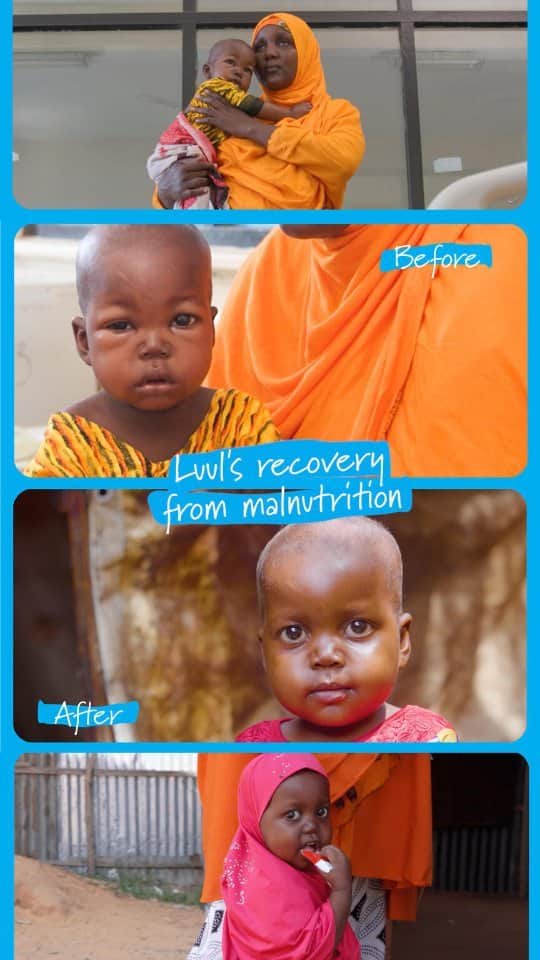 unicefのインスタグラム：「Seeing Luul suffering from severe malnutrition filled her mother with fear in Somalia.  These are the key treatments which helped power her back to health.」