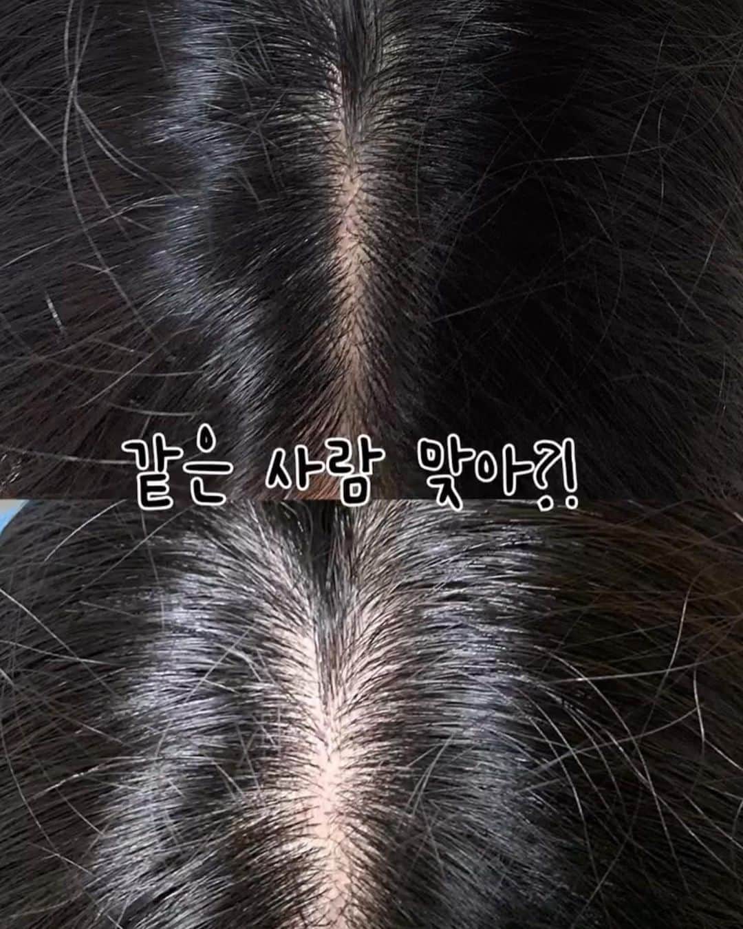 キム・ドヒさんのインスタグラム写真 - (キム・ドヒInstagram)「- 머리가 정말로!! 자라는 잔디세럼 open💚(후기가 대박이에요) 2개 구성은 무려 54% 할인으로 완전 추천드립니다!!  진짜 근 몇년 이래 “역대급 제품”이지 않을까 싶어요😆 하루 두번 발라주는게 가장 좋지만 하루 한번도 괜찮아요!!  ❓샤워 후, 젖은 머리에 문질문질 해주면 끝!!!  끈적임 ❌ 떡짐 ❌  맘놓고 듬뿍듬뿍 발라주셔도 되세용!!  ✅ 염색 탈색으로 머리가 많이 빠진분들 ✅ 스트레스로 머리 빠진 분들 ✅ 출산으로 머리 빠진분들  키에라 헤어에센스는  정수리에 빠진 부분,M자 부분 애교머리 부분 거기에 머리가 조금 난다는 헤어세럼이라더라구요  3년 전, 탈색을 4-5번 하고 아예 머리가 빠지기도 하규 머리 뚜껑 부분이 서서히 다 끊겼고  이제야 끊긴 부분들이 어깨 넘을 정도로 길었거든요   2,3년을 끊긴 머리 때문에 너무 고생을 해서 조금이라도 자란게 너무 다행이었지만  탈색으로 인해서 빠진 머리들은 다시 안나더라구요....?ㅠㅠ  누구나 그렇듯 귀찮아서 첨엔 바르는둥 마는둥 하다가 담당자 분께서 중간 점검차 연락 주셨는데 믿고 발라보라고 강력하게 말씀하셔서 안내 받은대로 샤워 후, 젖은머리에 매일매일 발라주었어요  속는셈 치고 M자 애교 머리 한쪽 발라봤는데 ( 비교 해보려구요 ) 조금씩 조금씩 나는게 보여서 왼쪽에 엄청 열심히 발라줬는데 비교사진 보시면 아시겠지만 잔머리 밀도가 다른거 보이시죠???  사진 봐주세요!!! . . #워터데이지#워터데이지마켓#공구#에스테틱#에스테틱공구#헤어에센스」11月6日 12時21分 - dohya_kh