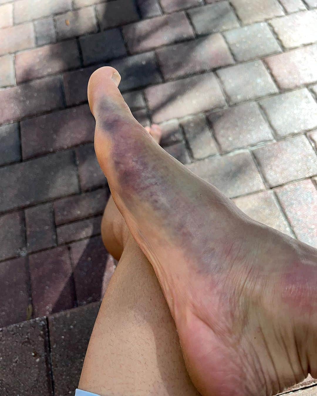 ケン・ロックゼンのインスタグラム：「Got a bit of bruising in my foot from the weekend. It ll buff out! I m going to try and ride tomorrow or the next day and we should be back in business 👍🏽」