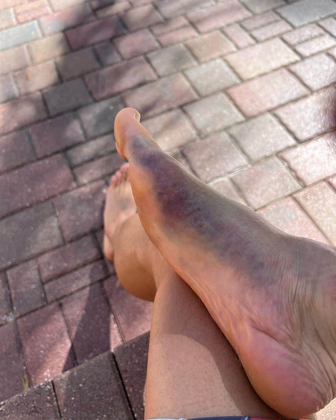 ケン・ロックゼンさんのインスタグラム写真 - (ケン・ロックゼンInstagram)「Got a bit of bruising in my foot from the weekend. It ll buff out! I m going to try and ride tomorrow or the next day and we should be back in business 👍🏽」11月7日 1時14分 - kenroczen94