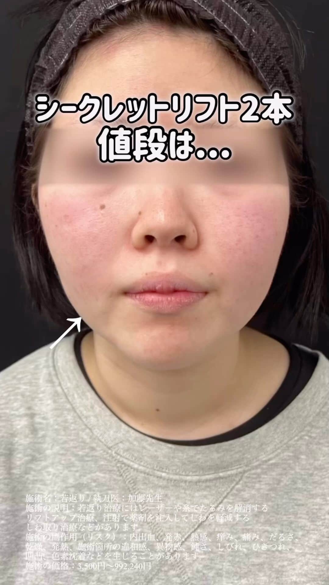 【公式】湘南美容外科クリニックのインスタグラム：「SBC社員に大人気の糸リフト✨ シークレットリフトの症例写真です🤳  従来の硬い糸とは異なり、柔らかく柔軟性のある特殊な混合スレッドで、引きつれが起こりにくく自然な引き上げが可能🔝 吸収されるまでの期間は約1年半と、持続力も格段にUP🉐  ご予約は @ibc_style まで✨✨ ⁡  施術名：シークレットリフト 施術の説明：柔らかく柔軟性のあるリフティング用スレッドを肌に挿入し、たるみを引き上げる施術です。 施術の副作用（リスク）：傷・疼痛・腫れ・内出血・ひきつれ・神経障害を生じる可能性があります。 施術の価格：44,000円(2本)～  執刀医： @sbc_kato ⁡ #湘南美容クリニック #イテウォンビューティークリニック #オルチャン #ダウンタイムが少ない #小顔になりたい #糸リフト #美容整形 #美容整形 #小顔治療 #整形 #ビフォーアフター #美容クリニック #イテウォンビューティークリニック新大久保院 #イテウォンビューティークリニック南青山院 #イテウォンビューティークリニック名古屋栄院 #イテウォンビューティークリニック大阪心斎橋院 #イテウォンビューティークリニック福岡天神院」