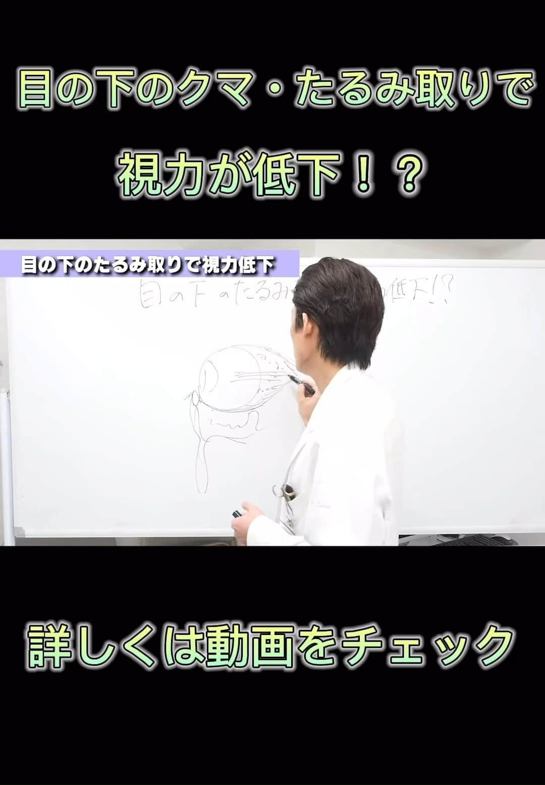 東京イセアクリニックのインスタグラム：「目の下のたるみ取りで視力低下！？  詳しくはこちらから https://youtu.be/NBdrBKIKQO8?si=7eh653rZ1b4rV69S  #目の下のクマ #目の下のたるみ #クマ #美容整形 #東京イセアクリニック」