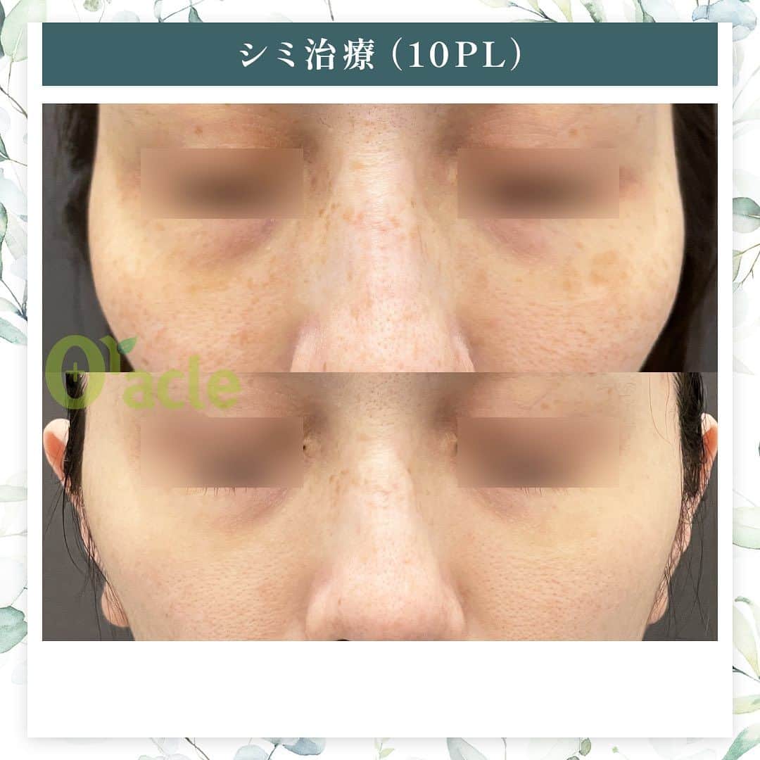 オラクル美容皮膚科東京新宿院さんのインスタグラム写真 - (オラクル美容皮膚科東京新宿院Instagram)「◤薄いシミの治療◢| 《治療内容》10PL 3回 他のIPLで治療後取りきれなかった薄いもやっとしたシミに対して、3回の治療を行いました。  ☑️10PL 韓国Oracle統括院長　ノ・ヨンウ医師開発 世界初の技術『フラクショナルIPL』搭載 ➡︎特許取得  安全性 ・韓国MFDS承認機器 ・アメリカFDA承認機器  治療目的：シミそばかすの除去、肌の再生  【ダウンタイム】 赤み：3〜5日 瘡蓋：7〜10日　※テープ保護不要 洗顔：当日 メイク：当日から可能ですが、ひりつきが出ますので翌日から推奨 ⁡ 【料金】 1回38,500円税込（鎮静管理込み）  ※目周りを除く  🉐初回セット 初回セット35,000円税込（鎮静管理込み） オプション：目周り8,800円 ⁡ #シミ　#薄いシミ  #シミ取り　#シミ治療 #シミ取りレーザー #そばかす #10pl #フラクショナルレーザー #IPL #IPLレーザー #美肌　#美白 #美容皮膚科 #韓国美容　#韓国好きな人と繋がりたい #韓国クリニック」11月8日 17時49分 - oraclejp