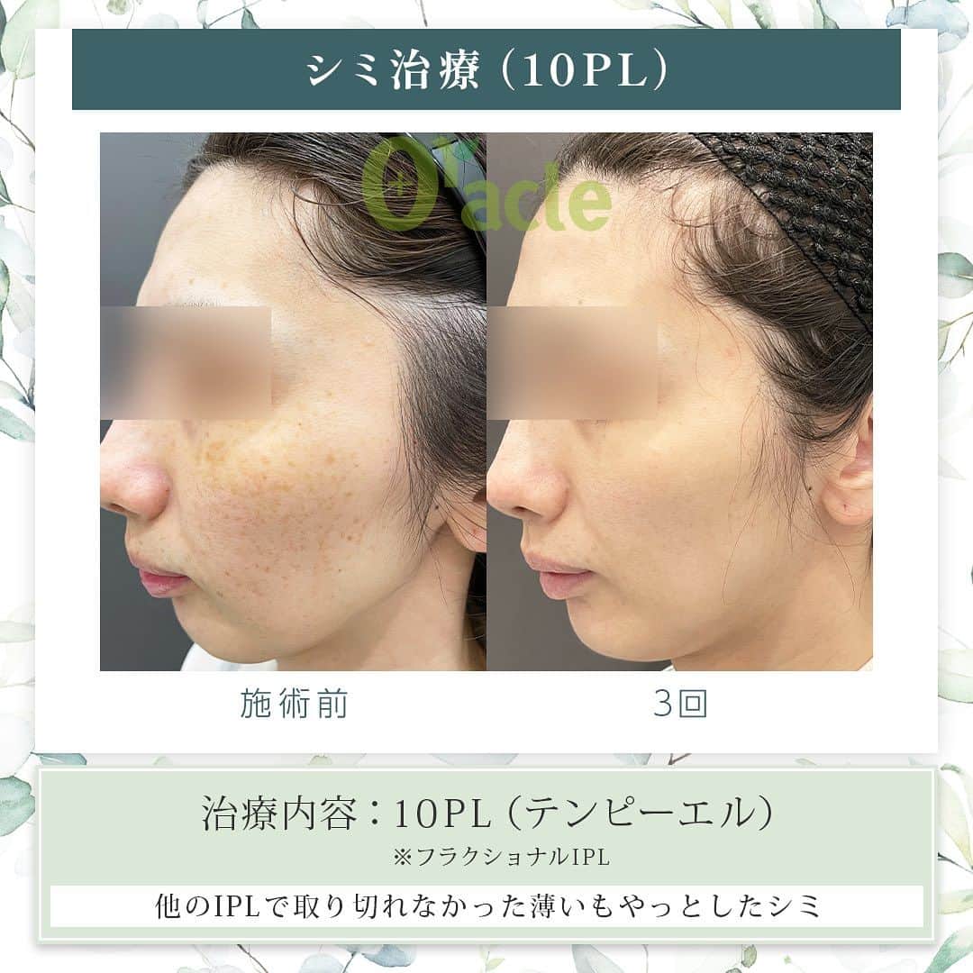オラクル美容皮膚科東京新宿院のインスタグラム：「◤薄いシミの治療◢| 《治療内容》10PL 3回 他のIPLで治療後取りきれなかった薄いもやっとしたシミに対して、3回の治療を行いました。  ☑️10PL 韓国Oracle統括院長　ノ・ヨンウ医師開発 世界初の技術『フラクショナルIPL』搭載 ➡︎特許取得  安全性 ・韓国MFDS承認機器 ・アメリカFDA承認機器  治療目的：シミそばかすの除去、肌の再生  【ダウンタイム】 赤み：3〜5日 瘡蓋：7〜10日　※テープ保護不要 洗顔：当日 メイク：当日から可能ですが、ひりつきが出ますので翌日から推奨 ⁡ 【料金】 1回38,500円税込（鎮静管理込み）  ※目周りを除く  🉐初回セット 初回セット35,000円税込（鎮静管理込み） オプション：目周り8,800円 ⁡ #シミ　#薄いシミ  #シミ取り　#シミ治療 #シミ取りレーザー #そばかす #10pl #フラクショナルレーザー #IPL #IPLレーザー #美肌　#美白 #美容皮膚科 #韓国美容　#韓国好きな人と繋がりたい #韓国クリニック」