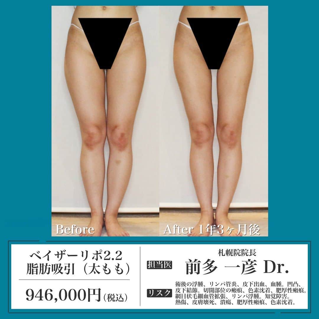 聖心美容クリニック公式アカウント さんのインスタグラム写真 - (聖心美容クリニック公式アカウント Instagram)「. ＼【20代女性・太もも-9cm細く美脚に】ベイザー脂肪吸引（1年3ヶ月後）✨／  20代女性です。 ダイエットではなかなか得づらい、美脚を手に入れるためにベイザー脂肪吸引の施術を受けていただきました🏋️‍♂️  Afterは術後1年3ヶ月の状態です！ 太ももは左右とも-9cm細くなり、 美脚効果も抜群だと思います💓  症例紹介アカウント（ @seishin_beforeafter ）で他の症例もチェックしてみてくださいね💕  一人ひとりのご希望に寄り添う丁寧なカウンセリング🏥 あなたの悩みに最適なオンリーワンの施術を🌷 聖心美容クリニックの無料カウンセリングは下記からお気軽にご連絡ください✨  ･+････+････+････+･･ 📲WEB予約：プロフィールからリンクをクリック　@seishinbiyou 📞電話予約：0120-112-614 🍀LINE予約：「聖心美容クリニック」で検索 ･+････+････+････+･･  ---------------------------  👨‍⚕️担当医 札幌院院長 前多 一彦 ( @seishin_maeda )  💉施術名 ベイザーリポ2.2 脂肪吸引（太もも）  🌱施術内容  吸引部に麻酔用Tumescent溶液注入。その際吸引カニューレ挿入用に小切開を加える。吸引装置で吸引。余剰な浸出液をドレナージ後、小切開部位縫合。圧迫固定。  ⚠️リスク・副作用  術後の浮腫、リンパ管炎、皮下出血、血腫。凹凸、 皮下結節。切開部位の瘢痕、色素沈着、肥厚性瘢痕。 網目状毛細血管拡張、リンパ浮腫。知覚障害。 熱傷、皮膚壊死、潰瘍、肥厚性瘢痕、色素沈着。  💰費用 946,000円（税込）  ---------------------------  #脂肪吸引 #ベイザー脂肪吸引 #太もも脂肪吸引 #ダイエット #部分痩せ #ベイザーリポ  #美容クリニック  #美容整形  #美容医療  #美容皮膚科  #とことん真面目に美容医療  #聖心美容クリニック #聖心美容クリニック札幌院」11月9日 17時47分 - seishinbiyou