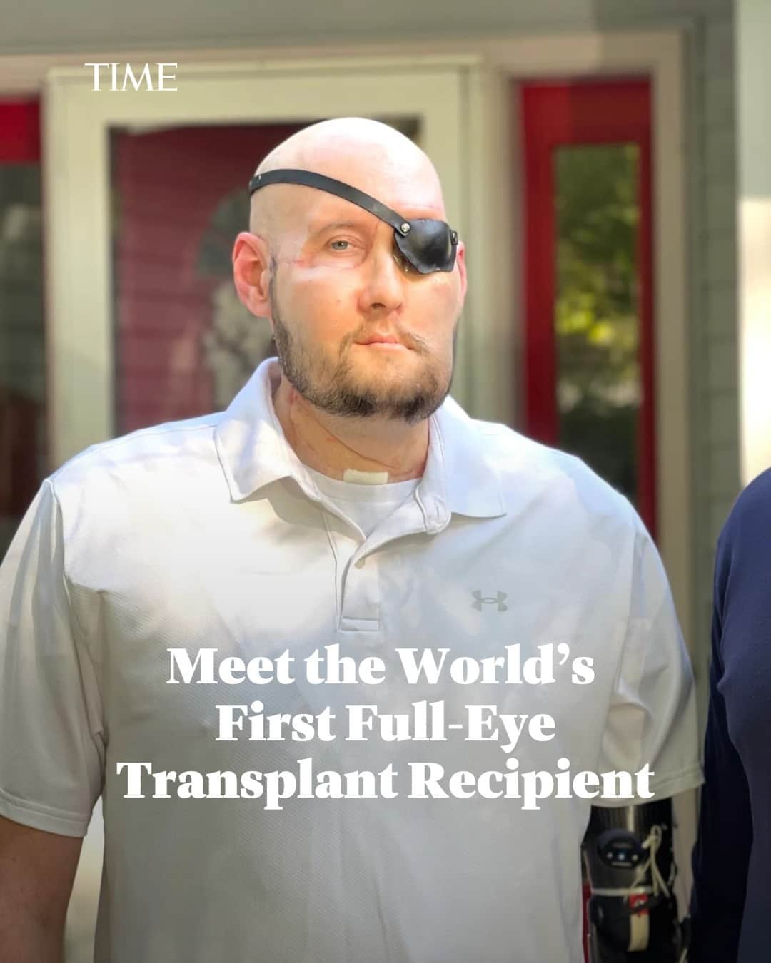 TIME Magazineのインスタグラム：「Surgeons at NYU Langone Health have performed what they say is the world’s first whole-eye transplant, combined with a partial face transplant, in an important step forward for the fields of both transplantation and vision restoration.  In May, a team of more than 140 health care workers performed the 21-hour procedure on Aaron James, a 46-year-old Arkansas man badly injured in a workplace accident in 2021. James, a high-voltage power lineman and military veteran, suffered a massive electric shock when his face accidentally touched a live wire on the job. James was lucky to survive, but lost his left eye, much of his face, and part of his left arm.  It’s not clear whether James will ever be able to see from his donated eye. Still, the novel combined transplant has given James major cosmetic benefits and improved his ability to speak and eat solid food—meaning that, for the first time since his accident, he’ll be able to enjoy a Thanksgiving meal with his family this year.   The nearly two years since the accident have been a test “of strength, will power, family, friends,” James said during a Nov. 9 press conference. “And I think we beat it.”  Learn more about James' story at the link in bio.  Photograph courtesy Russ Geltman/NYU Langone Health」