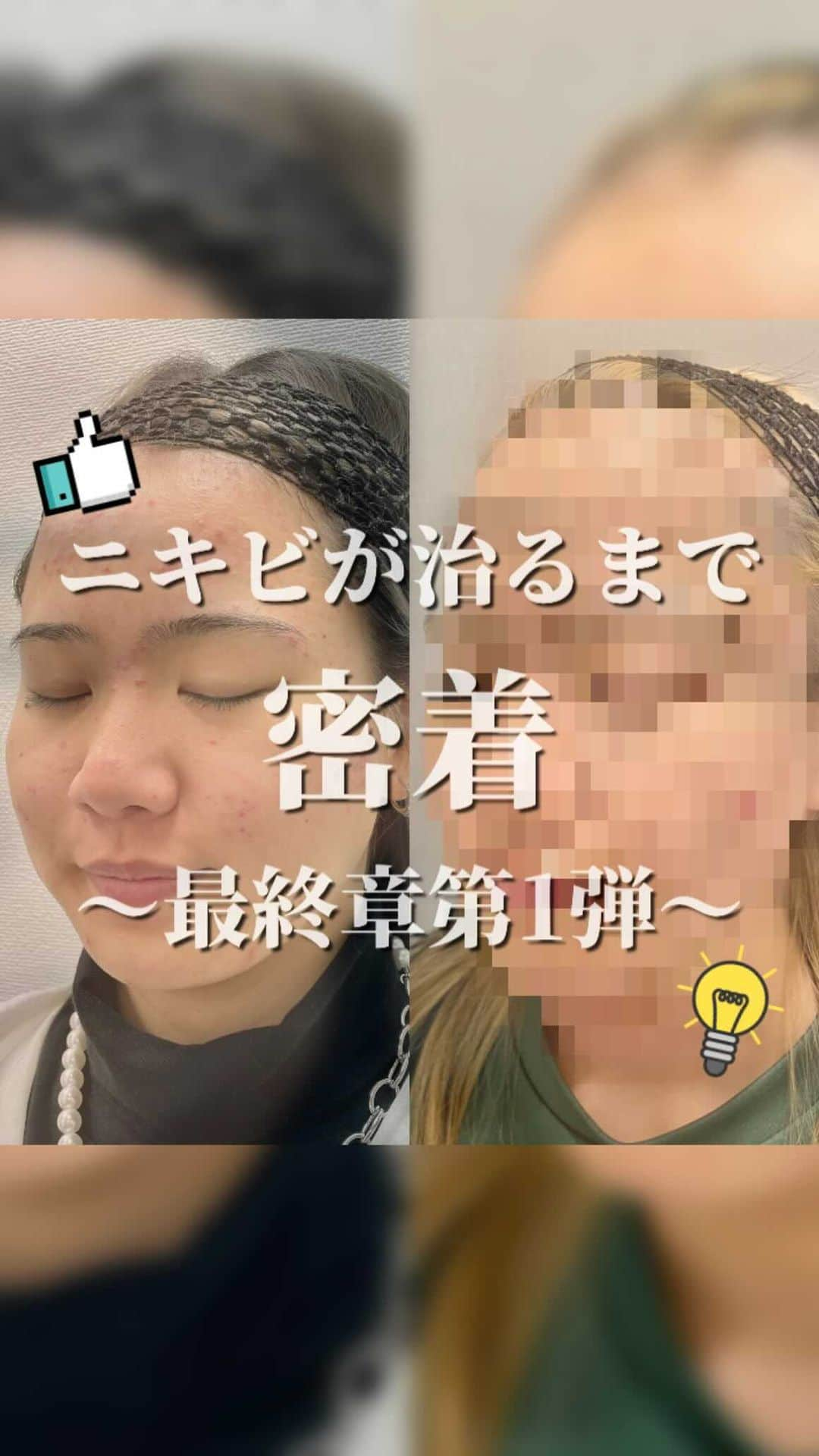 オラクル美容皮膚科東京新宿院のインスタグラム：「ニキビ治療で密着している りりかさん ⁡ いよいよ最終回、、、！ 今回は\\最終章 第1弾//をご紹介😉 ⁡ 昨年の5月から始めた密着 お肌もかなり綺麗になりましたㅜㅜ✨ ⁡ ニキビの治療が終わってからは 10PLのニキビ跡治療に切り替え、 トータルで1年以上治療を頑張ってくれました😭 ⁡ 治療を始めたころはニキビのせいで 少し自信を失っていたというりりかさんㅜㅜ ⁡ お肌が綺麗になって自信を取り戻すことが できたのか？！ ⁡ ⁡ ⁡ 動画の全貌はオラクルのYouTubeチャンネルで 配信しているので ぜひチェックしてみてください🤩 ⁡ ⁡ ⁡ 最終回 第2弾もお楽しみに✨ ⁡ ⁡ ⁡ #ニキビ #ニキビ治療 #ニキビ跡  #ニキビケア  #赤み #美肌  #美容皮膚科 #韓国美容 #美肌になりたい」