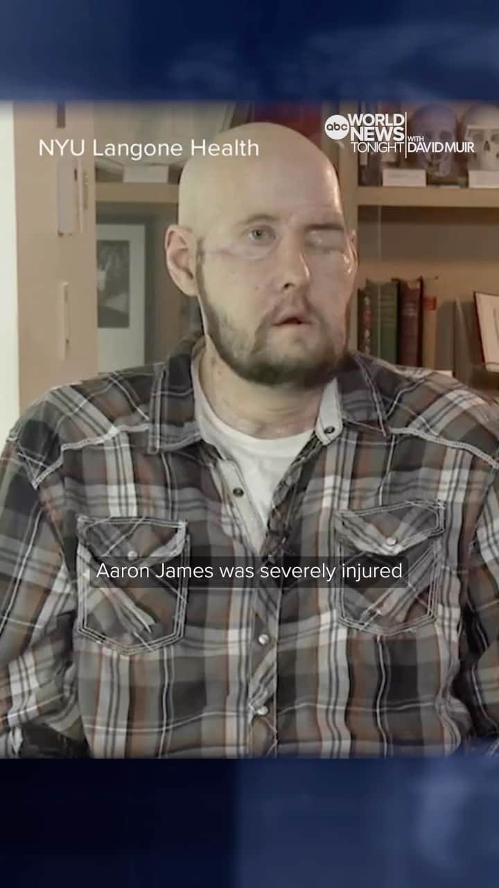 ABC Newsのインスタグラム：「After a high-voltage electrical accident, U.S. military veteran Aaron James has become the first patient to receive a complete eye and partial face transplant. His surgeon called the procedure “uncharted territory.” @davidmuirabc reports on the remarkable medical breakthrough.   #WorldNewsTonight #DavidMuir #ABCNews #News #VeteransDay #surgery」