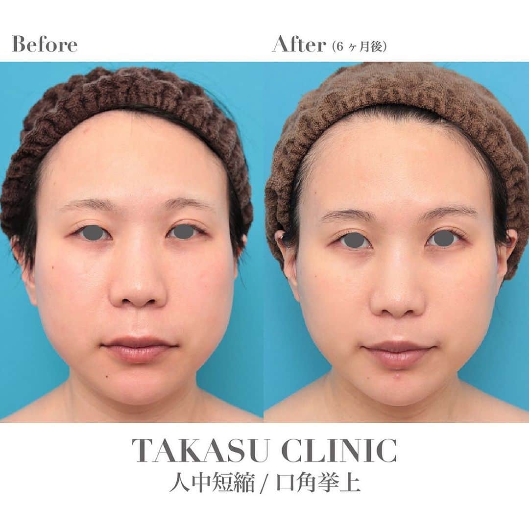 高須クリニック名古屋院のインスタグラム：「#repost @takasumikiya via @PhotoAroundApp  人中短縮と口角挙上を同時に行った20代女性の症例写真  【診療科目】鼻の下を短く（上口唇短縮手術、上口唇リフト、リップリフト、人中短縮術） / 口角拳上術  20代女性の患者様で、鼻の下が長いことや口角が下がっているのが悩みとのことでした。 診察させていただいたところ、確かに鼻の下はやや長めでした。 患者様は人中短縮手術を希望されていたため、人中短縮手術を行うことになったのですが、同時に口角挙上手術も希望されており、2つの手術を同時に行うことになりました。 手術は局所麻酔下に行い、人中短縮手術は鼻柱基部から鼻の穴の中を通るデザインで皮膚切開し、5mm弱皮膚切除し、口輪筋を縫合処理した後、丁寧に皮膚縫合しました。 口角挙上手術は人中短縮手術と同じくらいの幅で皮膚切除し、筋肉の縫合処理を行った後、丁寧に皮膚縫合しました。 手術後は自然な範囲内で適度に鼻の下が短くなって、口角も上がり、バランスの良い口元になりました。  【施術料金】 ●鼻の下を短く（上口唇短縮手術、上口唇リフト、リップリフト、人中短縮術）	 ¥385,000（税込） 【対象院】銀座高須クリニック・横浜院・名古屋院・大阪院  ●口角挙上術	 ¥385,000（税込） 【対象院】銀座高須クリニック・名古屋院・大阪院  【リスク・副作用・合併症】 ●鼻の下を短く（上口唇短縮手術、上口唇リフト、リップリフト、人中短縮術） 手術後に処方する抗生剤や痛みどめによるアレルギー症状  仕上がりのわずかな左右差（完璧なシンメトリーは不可）  仕上がりが完璧に自分の理想の形にならないことがある  ●口角挙上術 手術後に処方する抗生剤や痛みどめによるアレルギー症状  仕上がりのわずかな左右差（完璧なシンメトリーは不可）  仕上がりが完璧に自分の理想の形にならないことがある  【ご予約・お問い合わせ】 名古屋院☎︎ 052-564-1187 名古屋院📱 @takasuclinic_nagoya ↑名古屋院インスタのプロフィール画面からも直接コンタクトが取れます📲 https://www.takasu.co.jp/ ⁡ ⁡ #高須クリニック #高須クリニック名古屋院 #高須幹弥 #高須英津子 #美容整形 #整形 #ヒアルロン　#口角挙上 #人中短縮 #ビフォーアフター」