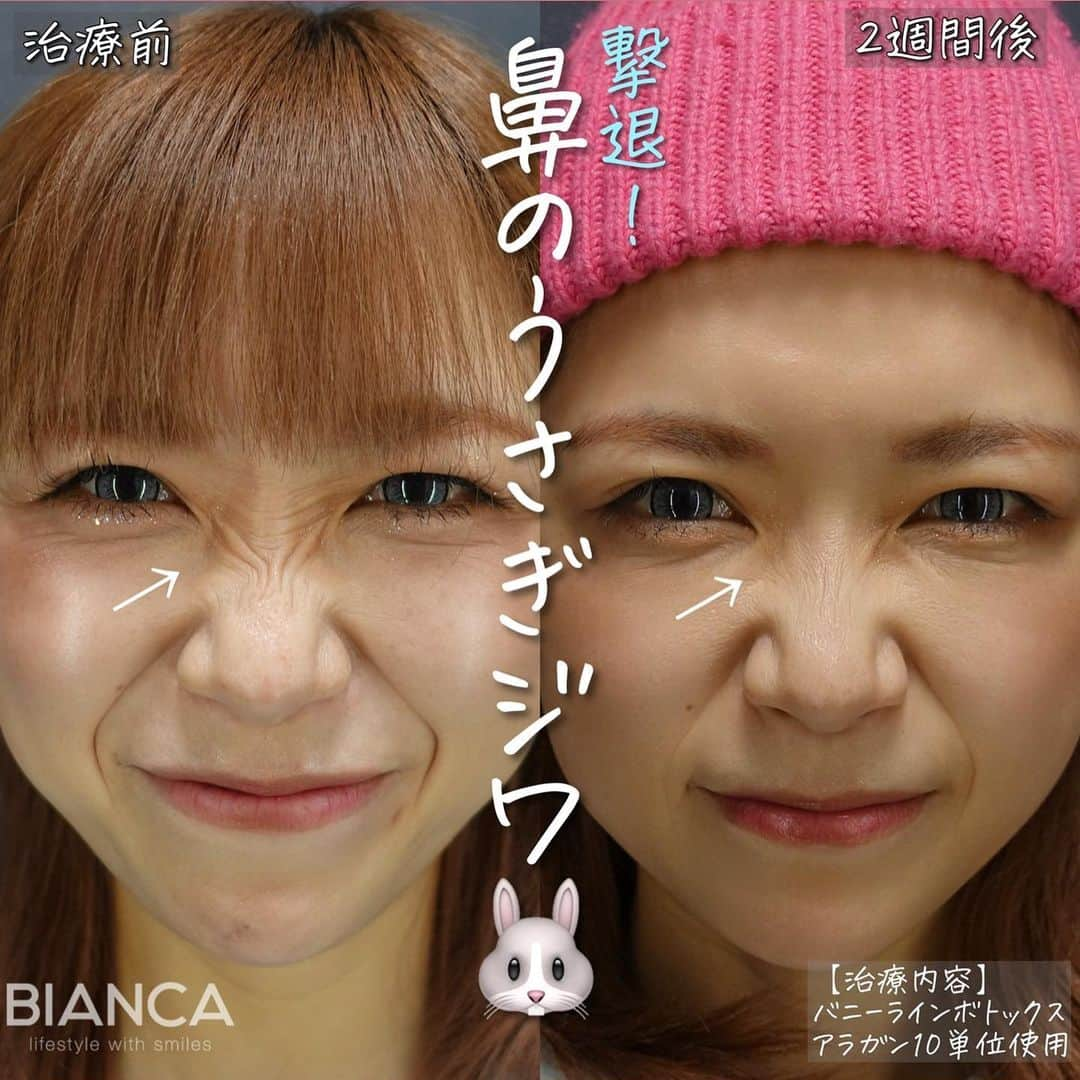 辻沢由有（BIANCA CLNIC 表参道院 院長）さんのインスタグラム写真 - (辻沢由有（BIANCA CLNIC 表参道院 院長）Instagram)「バニーライン🐰ボトックス💉✨  鼻根の横ジワ、通称「バニーライン」 表情が豊かな方によく見られますが ボトックス注射で綺麗に治療できます☺️✨  ▶︎ボトックス注射 アラガン10単位使用 660円＋税/単位 別途施術料 22,000円＋税  ✽.｡.:*・ﾟ ✽.｡.:*・ﾟ ✽.｡.:*・ﾟ ✽.｡.:*・ﾟ ✽.｡.:*・ﾟ  📝ご予約はwebが便利です✨ プロフィール欄のリンクからご予約ください。 ※医師指名可能（“大久保医師指名”をクリック） ※診察料はかかりません🙅‍♀️ ※表参道院勤務が9割となっています。  📍BIANCA CLINIC ※お電話頂くと自動音声通話に繋がります。 ✔︎表参道院 ☎️05018071593 東京都港区南青山5-11-10  南青山511ビル 2F ✔︎銀座院 ☎️05031964834 東京都中央区銀座1-8-19 キラリトギンザ12F  •診療時間 10:00〜19:00 •年中無休（年末年始を除く）   ✽.｡.:*・ﾟ ✽.｡.:*・ﾟ ✽.｡.:*・ﾟ ✽.｡.:*・ﾟ ✽.｡.:*・  #ボトックス #バニーライン  #シワ改善  #ボトックス注射  #シワ対策」11月12日 12時56分 - i_am_yuu__