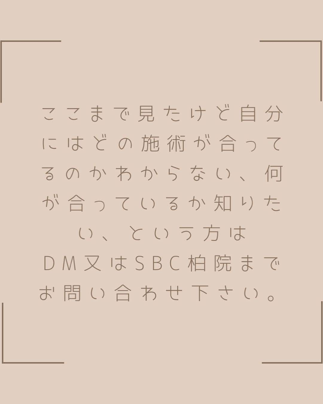 湘南美容外科 柏院さんのインスタグラム写真 - (湘南美容外科 柏院Instagram)「【クマ取り経験者によるダウンタイムを抑えたクマ取り！】 ↓↓↓ 自らもクマ取りをしたからこそわかる、ダウンタイムの経過や痛み、気をつけることについてカウンセリングでしっかりとお伝えします！  症例は 目の下のタルミ取り＋脂肪注入（目の下・ゴルゴ） 術前後1週間の経過です！  術前は目の下の膨らみが目立ち、またその下の凹みによって疲れた印象、老けた印象になっています。 目の下の膨らみに対してクマ取り、 また取った後の凹みと元々の目の下の凹み（ゴルゴ線、ほうれい線）に対して脂肪注入を行っいました！  脂肪注入を多めにするため、1週間の時点ではやや膨らんでいます。 最終的な完成は3ヶ月後ですが、腫れ自体は1週間程度で大分改善しています！✨  施術名：目の下の切らないクマ・たるみ（ふくらみ）取り 施術の説明：お顔表面を切らずに目の下の余分な脂肪を取り除き、ハリのある生き生きとした目元にする施術です。 施術の副作用（リスク）：だるさ・熱感・頭痛・蕁麻疹・痒み・むくみ・発熱・咳・冷や汗・胸痛・膨らみが残る・まぶたが凹みすぎたと感じる・膨らみや凹み具合など、仕上がりに左右差があると感じる・目がゴロゴロする・若返り効果が物足りない・小ジワ・シワ・たるみが残る、または増加する・目尻がつっぱるなどを生じることがあります。 施術の価格：113,000円  施術名：コンデンスリッチフェイス法 施術の説明：濃縮したご自身の脂肪を注入して肌にハリを持たせ、しわを改善する治療です。 施術の副作用（リスク）：だるさ・熱感・頭痛・蕁麻疹・痒み・むくみ・発熱・咳・冷や汗・胸痛・吸引部の皮膚が硬くなる、凹凸になる・施術箇所の知覚の麻痺・鈍さ、しびれ・皮膚の色素沈着などを生じることがあります。 施術の価格：210,370円～354,750円  モニター応募は、プロフィールのリンクから。 モニター番号:020-0767  今なら、数量限定のお得なモニターも！👁👃 モニター番号 No.020-0806 モニター番号 No.020-0791  *・。*・。*・。*・。*・。*・。*・。*・。*・。*・。* 湘南美容クリニック柏院では、 中谷院長を筆頭にお客様一人ひとりに丁寧に向き合い、 最適・最善のアプローチをご提案させていただきます。 カウンセリングでは、 どんな些細なことでも気になることがあればご相談ください。  湘南美容クリニック柏院 JR常磐線柏駅 南口より徒歩3分 Day Oneタワー2階 診療時間:10:00〜19:00 📞0120-489-750 @sbc_kashiwa  #湘南美容クリニック #湘南美容外科 #クマ取り #脂肪注入 #脂肪注入ダウンタイム  #若返り #目の下のたるみ取り #目の下のクマ  #柏 #松戸 #取手 #我孫子」11月12日 18時33分 - sbc_kashiwa