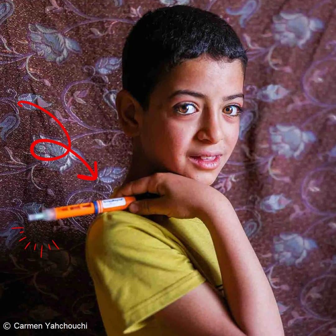 国境なき医師団のインスタグラム：「【今日は #世界糖尿病デー 】 友達とサッカーをするのが好きな、10歳のムーサ君。内戦のシリアから逃れ、難民としてレバノンで暮らしています。  3歳の時から1型糖尿病を患っている彼にとって、血糖値のコントロールのために欠かせないのが「インスリンペン」。以前は注射器を使っていましたが、インスリンペンだと痛みが少なく、自分で使うこともできると話します。ガラスを使わないので持ち運びにも適しています。  紛争などの人道危機下で糖尿病を患う人たちをはじめ、必要とするすべての人がインスリンペンを使えるようにすることが必要です。  #国境なき医師団 #MSF #医療援助 #糖尿病 #世界糖尿病デー #インスリンペン  #シリア #レバノン」