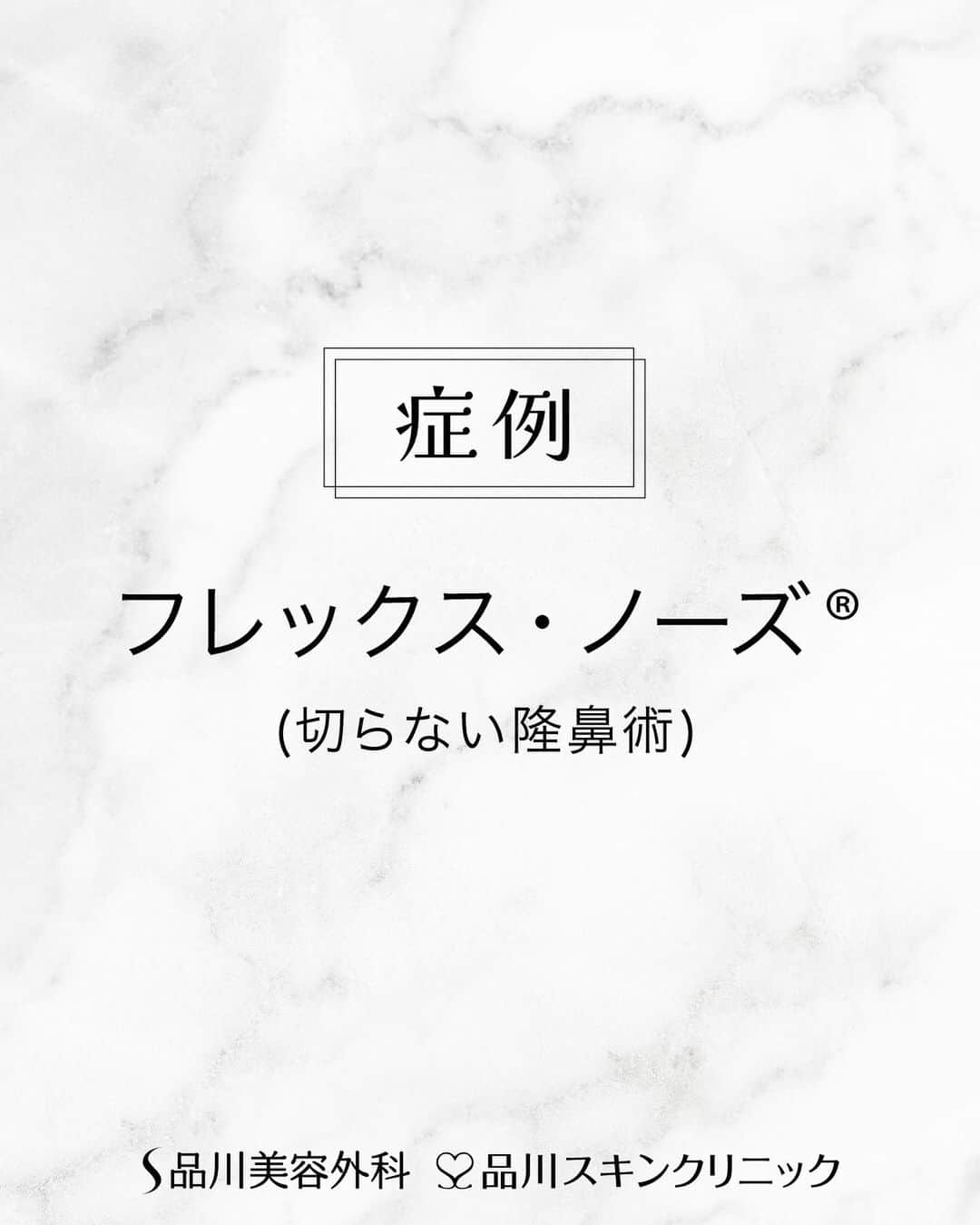 品川美容外科【公式】のインスタグラム：「施術1ヶ月後のお写真です✨ 糸で鼻の形をお好みの形に整える❣️ 　　 💎施術名 フレックス・ノーズ® (8本) 　　　 💎執刀医 品川美容外科 札幌院( @ssc_sapporo ) 中橋 佳子 院長 　　　 ┈┈┈┈┈┈┈┈┈┈┈┈┈┈┈┈　 　　 糸でお鼻の形を整える施術 【価格】15,840円～201,960円(税込) 【副作用・リスク】腫れ：3日～1週間位、数日間軽い痛み、内出血：1～2週間位 　　 ┈┈┈┈┈┈┈┈┈┈┈┈┈┈┈┈　　　   是非無料のカウンセリングでご相談ください✨   💎お問い合わせ 品川美容外科：0120-189-900 品川スキンクリニック：0120-575-900 プロフィール画面のURLからWEB予約が可能です💁 ▶@shinagawa.biyou 　　 💎BMC会員について 年会費無料で対象施術が20%OFFになるお得な会員システムです。(一部割引率の異なるメニューや対象外のメニューあり) 会員特典は入会当日より利用が可能。さらに誕生月は25%OFF＆＋1,000ポイント（入会手数料：税込550円） 詳しくはHPをご確認ください。   ※公的保険適用外となります。 ※掲載の全部または一部の治療は薬機法未承認の医療機器・医薬品を使用しています。医師の責任の下、個人輸入により治療を行っております。※個人輸入された医薬品等の使用によるリスク情報 https://www.yakubutsu.mhlw.go.jp/individualimport/   #品川美容外科 #品川スキンクリニック #美容 #美容医療 #美容皮膚科 #鼻 #隆鼻術 #糸 #プチ整形」