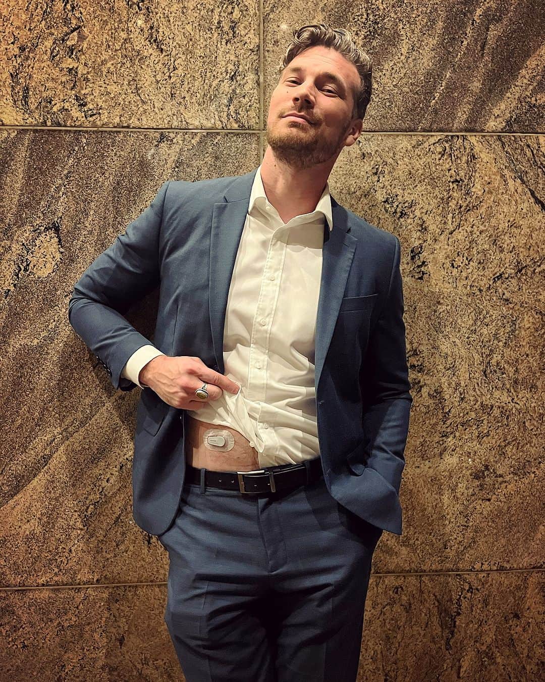 デレック・テラーのインスタグラム：「It’s officially NDAM and I am so thankful for everything Diabetes has given me. I was diagnosed at a young age, and spent many years feeling insecure about my condition, with very low self confidence. I was worried about acceptance, becoming a cyborg, my quality of life, building a family, and being able to do the things that I love.  What I want the world to know about Diabetes is: While it is a serious chronic disease, with responsibility and new technology like Dexcom CGM, you can accomplish anything!   I do my best to show people that living an adventurous life is possible. Now I hold my head high, I’ve come a long way, and I’m always evolving. If I can have a fulfilling life, and start the family of my dreams, you can too. Being part cyborg isn’t all bad.  On a sidenote. Because of the strike, I’ve had a lot of time to put into diabetes advocating. From speaking at Leadership Summits, to blitzing the capital with the JDRF, to promoting my documentary @breakinglimitsfilm. One of my favorite partnerships has always been Dexcom. The opportunities that I’ve had, and the people that I’ve met along the way have changed my life in the best way. Dexcom is one of my proudest partnerships, and I know this device is making a difference for people managing diabetes. With all that is accessible to us it’s a good time in history to be a diabetic.  #seediabetes #dexcompartner #DexcomWarrior #sponsored」