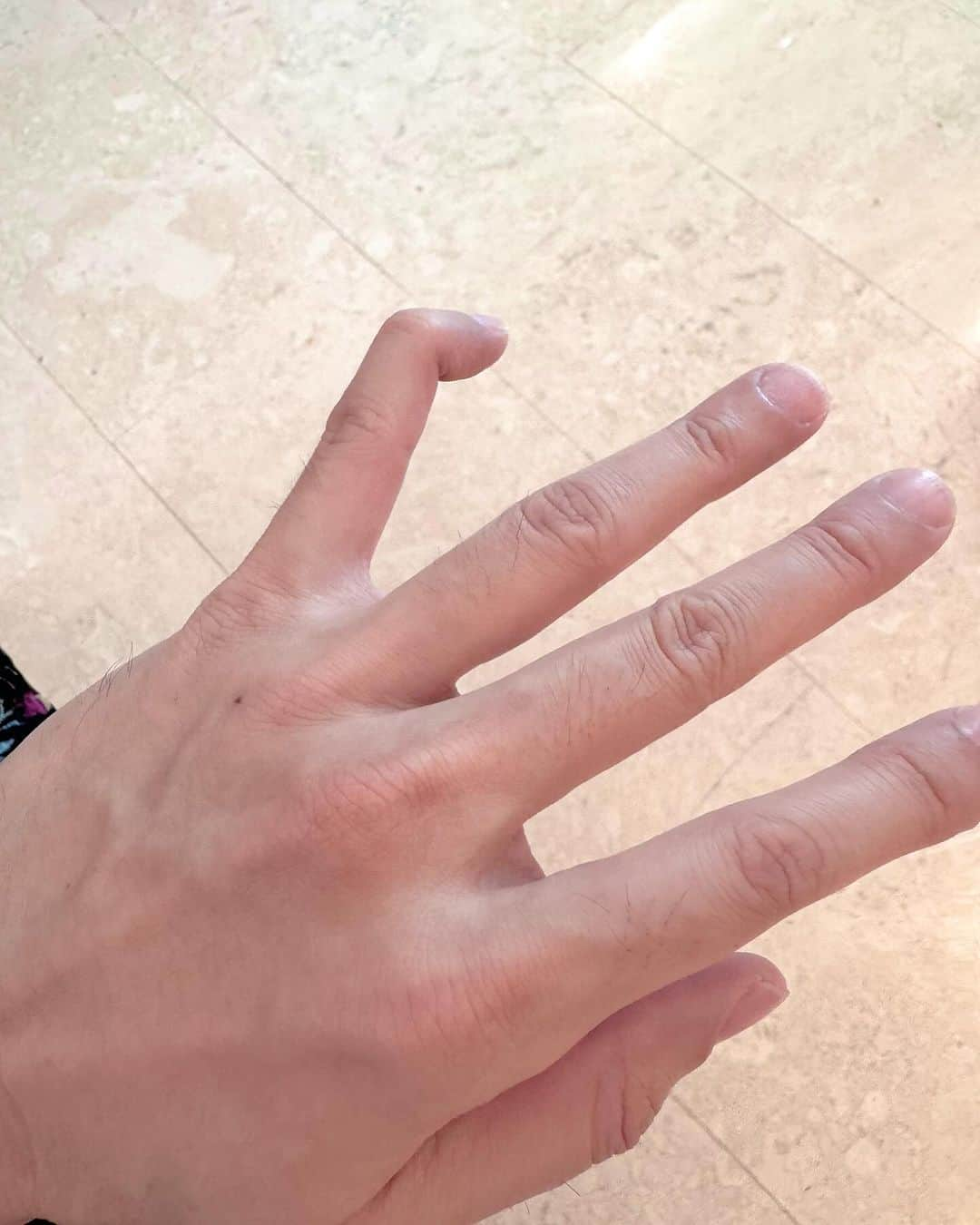 林俊傑さんのインスタグラム写真 - (林俊傑Instagram)「I wish this was a prank, but it's not.  I also wish I had a cooler story to tell, but I’m afraid not… I’ve injured my little finger. While trying to save a falling glass bottle, I accidentally hit my hand, and suffered a torn tendon to my pinky finger, and am unable to straighten it no matter how hard I try. Fortunately, X-Ray showed no sign of bone fracture. However, I will have to be wearing a finger cast from now on, 24/7 for the next 6 weeks, and hope that it will recover! Please do not worry about me, I will brace this and get well, like I always have!  昨天有人好奇我的手指怎麼了？其實我是為了「拯救」掉落的玻璃瓶，尾指肌腱受傷了… 醫生指示接下來6週必須戴著輔助器讓肌腱歸位。所幸筋骨無恙，希望6週以後肌腱能夠順利復原！不用擔心，會好的（一如往常）。  #malletfinger #iwillgetwellsoon #roadtoJJ20」11月15日 23時47分 - jjlin