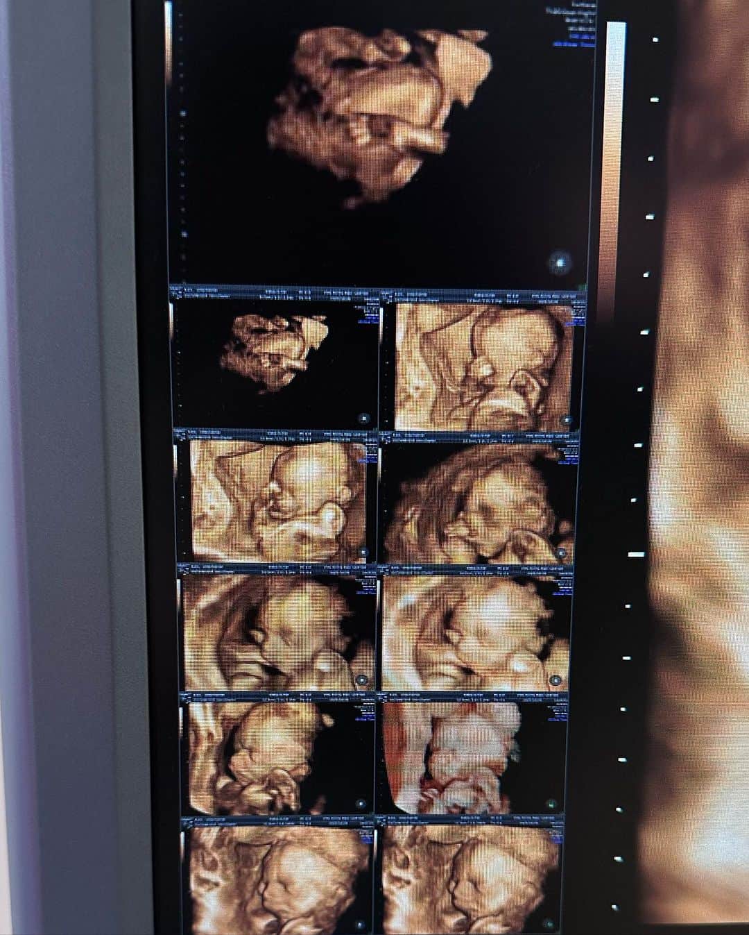郭圈圈さんのインスタグラム写真 - (郭圈圈Instagram)「有個生命在肚子裡的感覺真的很奇妙♥️ 尤其是當感受到胎動後 一切都好神奇🤩 - 每次產檢也都看到寶寶在肚子裡的成長 從胚胎到第一次聽到心跳💓 再從像一個小外星人😆到現在真的像個寶寶👶🏻 每一次都是都感受到滿滿的感動與愛🫶🏻 - 今天這組照片是去照 #高層次超音波 的時候 寶寶從外觀上到器官們一切都好💪🏻 還變表情給我們看😆太搞笑了 你們說說這是像阿恩還是像我🥰 . . . . #圈圈孕期記錄 #張教授胎兒醫學中心 #台南 #超音波 #孕期記錄 #孕媽咪 #新手媽媽」11月16日 12時36分 - helloiamlea