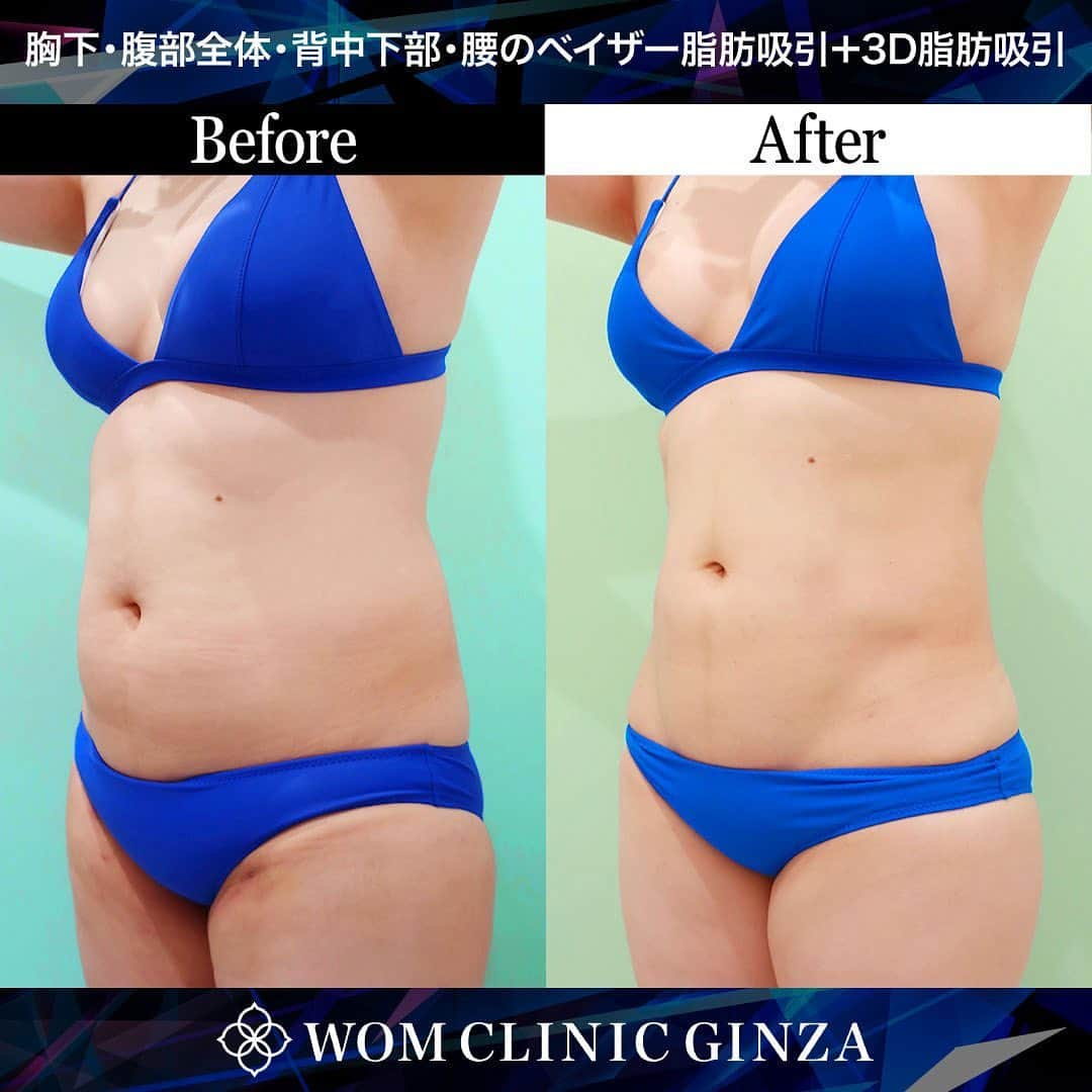 櫻井美沙季さんのインスタグラム写真 - (櫻井美沙季Instagram)「【みさみさ×WOM CLINIC】 🔥コラボ企画🔥  わたしの大切なスポンサーである @womclinicginza 様とのコラボ企画が始まりました🔥！  数々のボディビルダーやトレーニーの脂肪吸引を手がけてきた ベテランの先生にお任せすれば、ダウンタイム中でもトレーニングできます🙆‍♀️  脂肪吸引こそ、経験豊富で技術力の高い先生にお願いするべきです☝️  減量の後半になってから、「お腹周りがどうも落ちきらなくて…」  と相談にかけこむ方が多いそうなのですが、 オフシーズンのうちに脂肪吸引をし、物理的に脂肪細胞の数を減らしておくほうがオススメです🙆‍♀️  もちろん、トレーニングされていない方もぜひこの機会にご検討ください！🩵🩷  お腹・胸下の脂肪吸引をされる方には「3D脂肪吸引が無料」になります！！！  ※モニター応募方法は4枚目をご覧下さい🙆‍♀️  ※ミサミサのインスタ見た、とお伝えいただく必要があります✨️  ※ビフォーアフターの写真はわたしではなくモニター様の症例写真です✨️  #ワムクリニックギンザ #womclinicginza #脂肪吸引 #アブクラックス #腹筋割れたい #ミサミサコラボ」11月16日 14時25分 - misamisa_ifbb_figure_pro