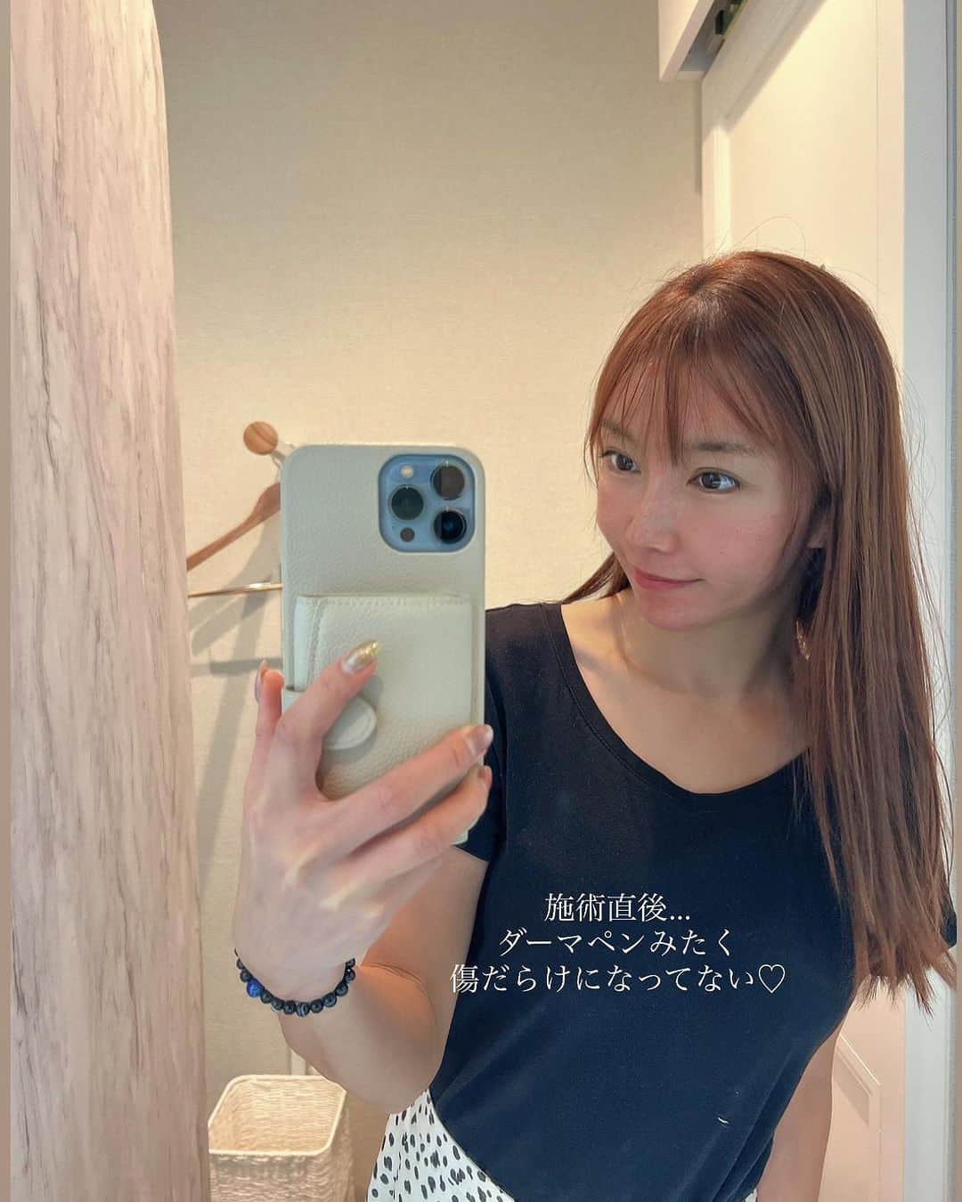 石関いづみさんのインスタグラム写真 - (石関いづみInstagram)「𝐁𝐞𝐚𝐮𝐭𝐲  𝐃𝐚𝐲  𓂃◌𓈒𓐍   夏に受けたお肌のダメージケアに @renataclinic でずっと気になっていた #ポテンツァ＋【エクソソーム導入】をしてきたよ🪽  #ダーマペン の進化版と言われていて 乾燥によって繰り返すニキビや小じわなど 肌質改善の効果があるんだって🫧  院内も清潔感があってオシャレで 何よりスタッフさんの対応がとても素晴らしかった🥹  麻酔クリームを効かせてから施術したので 痛みもチクチクするほど。 施術直後の赤ら顔も翌日にはちゃんと引いてた˵⍢⃝˵  綺麗なお肌を保つ為にまたやってもらう♡ リピーター決定🫶  #PR #レナータクリニック #renataclinic #renataclinic表参道 #エクソソーム #ポテンツァエクソソーム #アンチエイジング #美肌 #美容クリニック #お肌ケア #肌質改善 #ゆんころ」11月17日 11時47分 - izumingolf