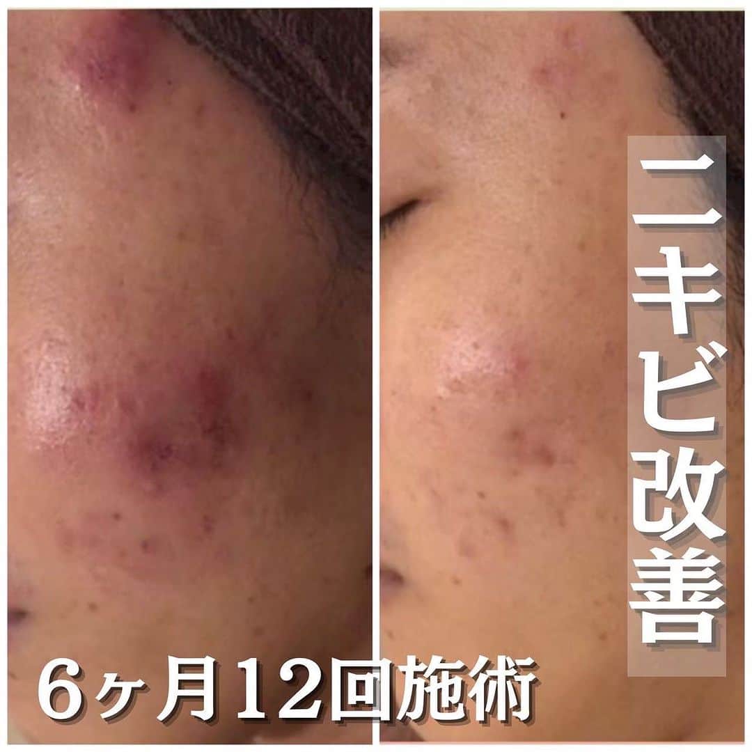 肌質改善専門サロン~Accueil~さんのインスタグラム写真 - (肌質改善専門サロン~Accueil~Instagram)「.  💌インスタのDM💌 ご希望日時・お名前・生年月日・お悩み内容をご明記の上ご連絡ください♡  🌿LINEの予約🌿 ご希望日時・お名前フルネームをご返信ください♡  📞お電話でのご予約📞 03-6912-5705にお願いします♡  ┅ ┅ ┅ ┅ ┅ ┅ ┅ ┅ ┅ ┅ ┅ ┅ ┅ ┅ ┅ ┅ ┅ ┅ ┅   なかなか治らないニキビ、ニキビ跡 繰り返しできるニキビに悩んでいる😭 という方いませんか❓  ニキビが出来てしまう原因は様々ですが 繰り返しできるニキビには根本改善が必要です❗️ 根本改善するには⚠️ 💆🏻‍♀️外側からのアプローチ(エステ、マッサージ) 🥗内側からのアプローチ(私生活、心身状況)  この両方のアプローチをすることで 肌トラブルから卒業できます🌸  Accueil(アクール)ではお肌の土台をしっかり作ること。 お肌を“与えるケア”から“ 鍛えるケア”をしていくことで一緒に肌トラブルから卒業することを目指しています☺️  気になった方はコメント、DMお待ちしております🎵  ┅ ┅ ┅ ┅ ┅ ┅ ┅ ┅ ┅ ┅ ┅ ┅ ┅ ┅ ┅ ┅ ┅ ┅ ┅ #ニキビ#ニキビケア#ニキビ跡#ニキビ改善#ニキビ肌#ニキビ治療#背中ニキビ#ニキビ跡ケア#ニキビ肌改善#ニキビ跡改善#エステ#エステ#エステサロン#エステキャンペーン中#毛穴#敏感肌#乾燥肌#すっぴん#肌質改善サロン#肌質改善#美容#池袋#恵比寿#銀座#表参道#渋谷#新宿#新大久保#原宿#美肌#美容女子」11月18日 16時10分 - accueil_ikebukuro